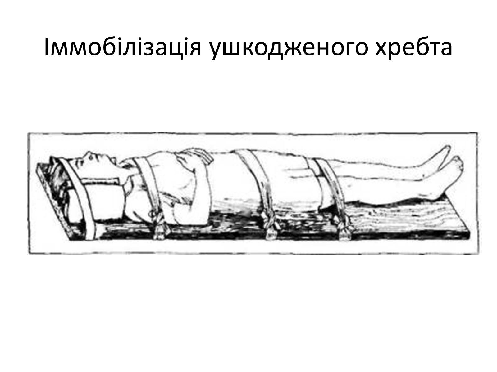 Презентація на тему «Переломи та вивихи. Перша допомога» - Слайд #20 Презентація на тему «Переломи та вивихи. Перша допомога» - Слайд #20