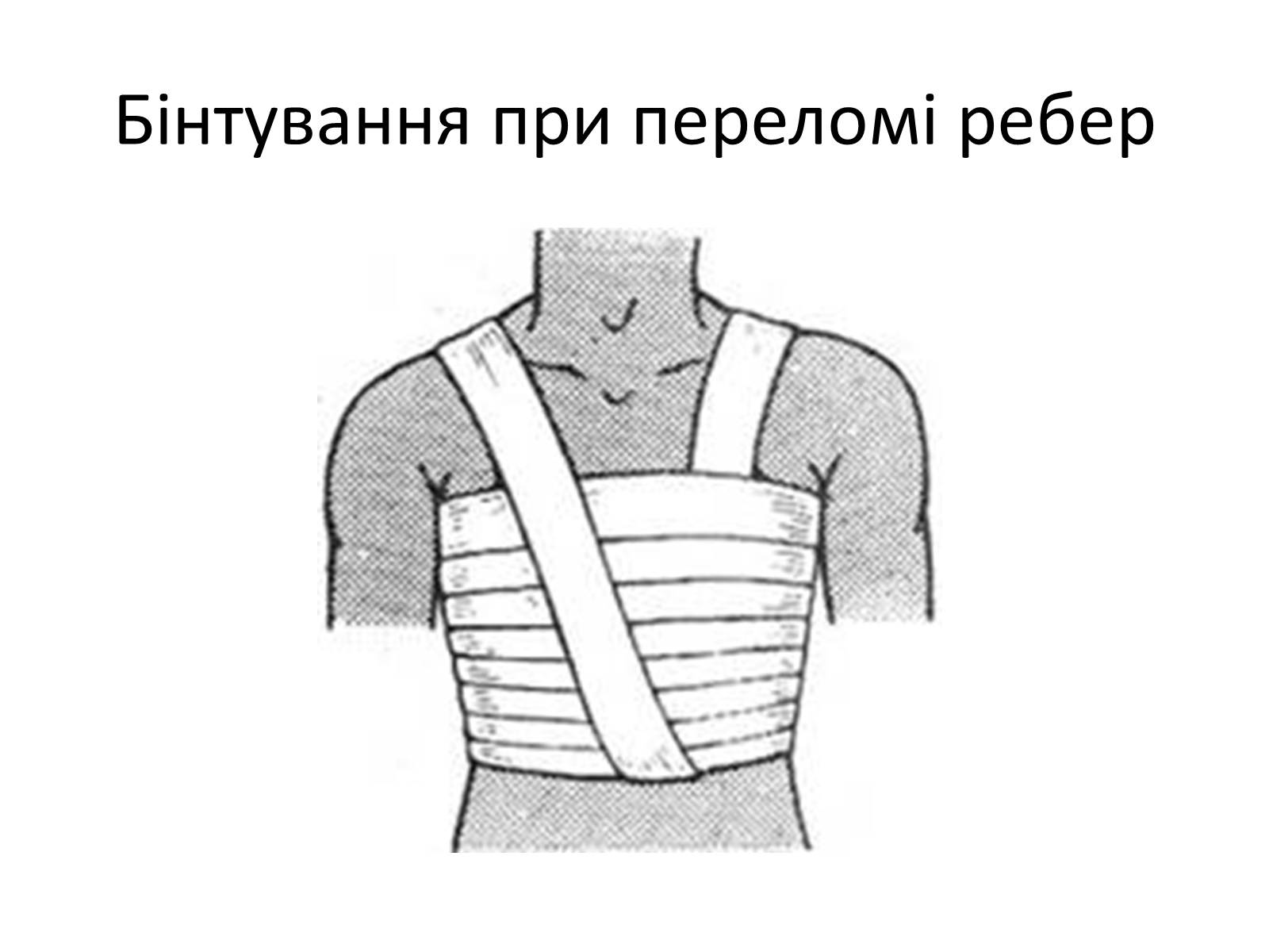 Презентація на тему «Переломи та вивихи. Перша допомога» - Слайд #22 Презентація на тему «Переломи та вивихи. Перша допомога» - Слайд #22