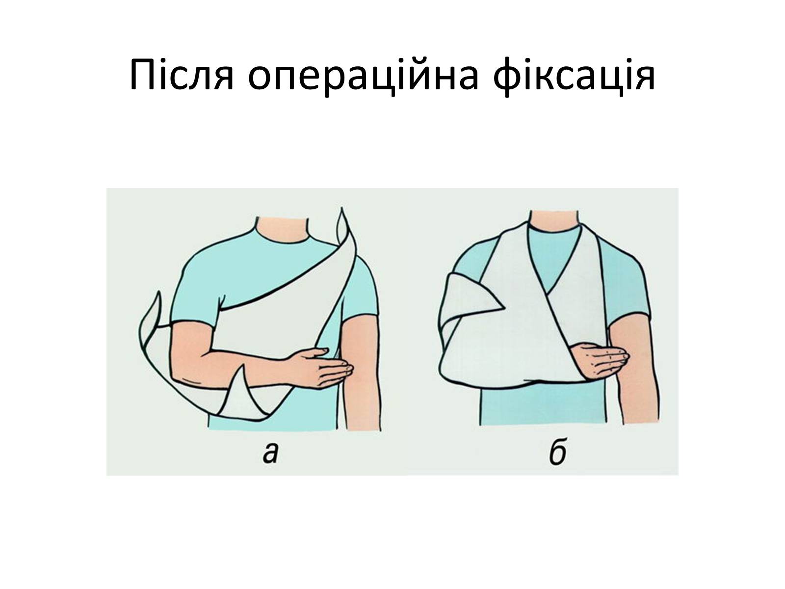 Презентація на тему «Переломи та вивихи. Перша допомога» - Слайд #9 Презентація на тему «Переломи та вивихи. Перша допомога» - Слайд #9