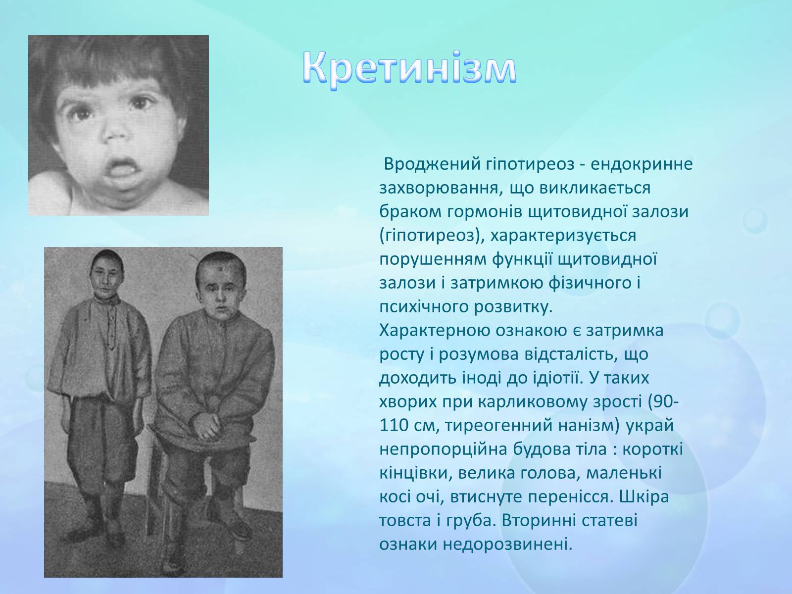 Презентація на тему «Щитоподібна залоза» - Слайд #7 Презентація на тему «Щитоподібна залоза» - Слайд #7