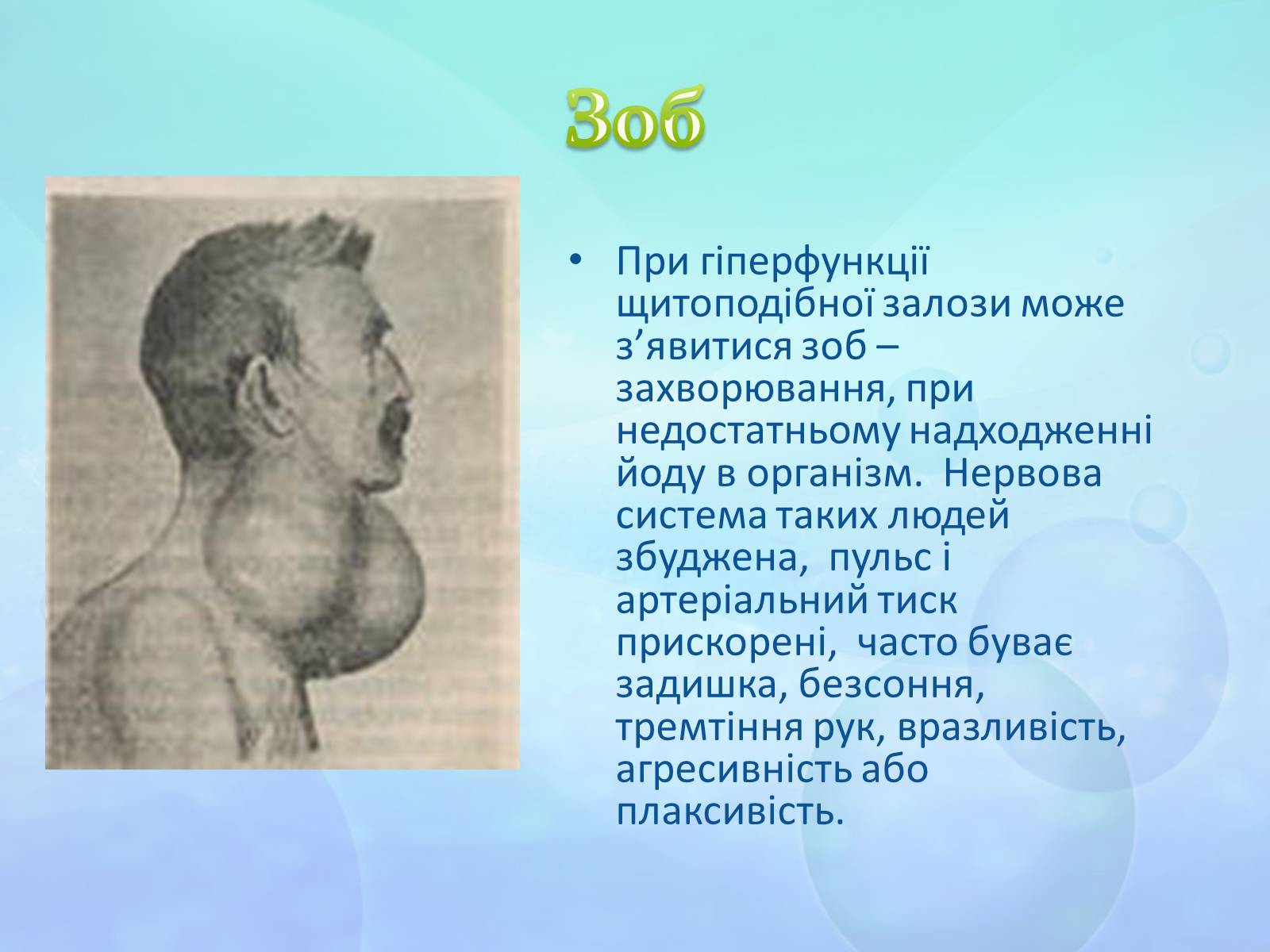 Презентація на тему «Щитоподібна залоза» - Слайд #8 Презентація на тему «Щитоподібна залоза» - Слайд #8
