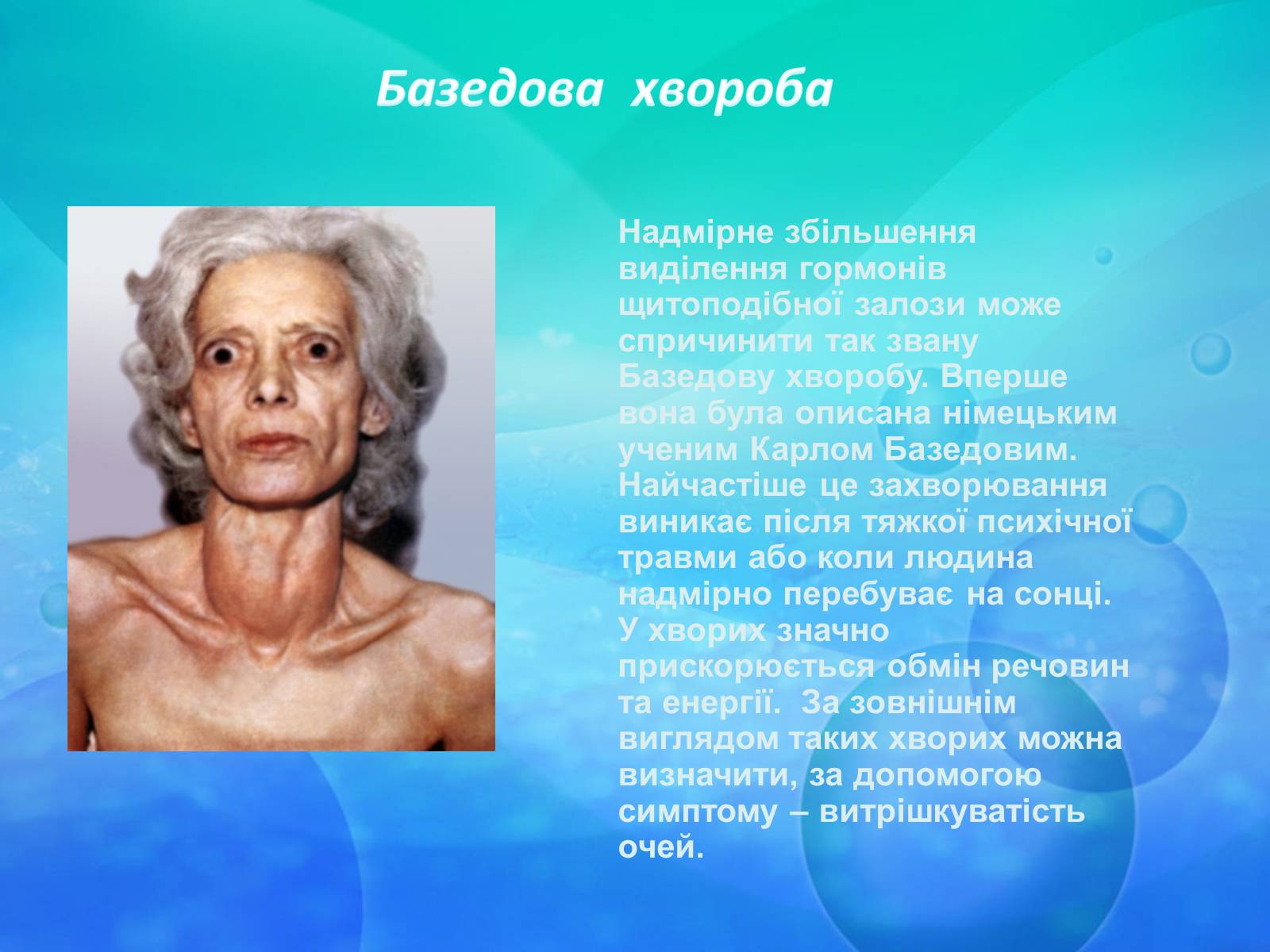 Презентація на тему «Щитоподібна залоза» - Слайд #9 Презентація на тему «Щитоподібна залоза» - Слайд #9