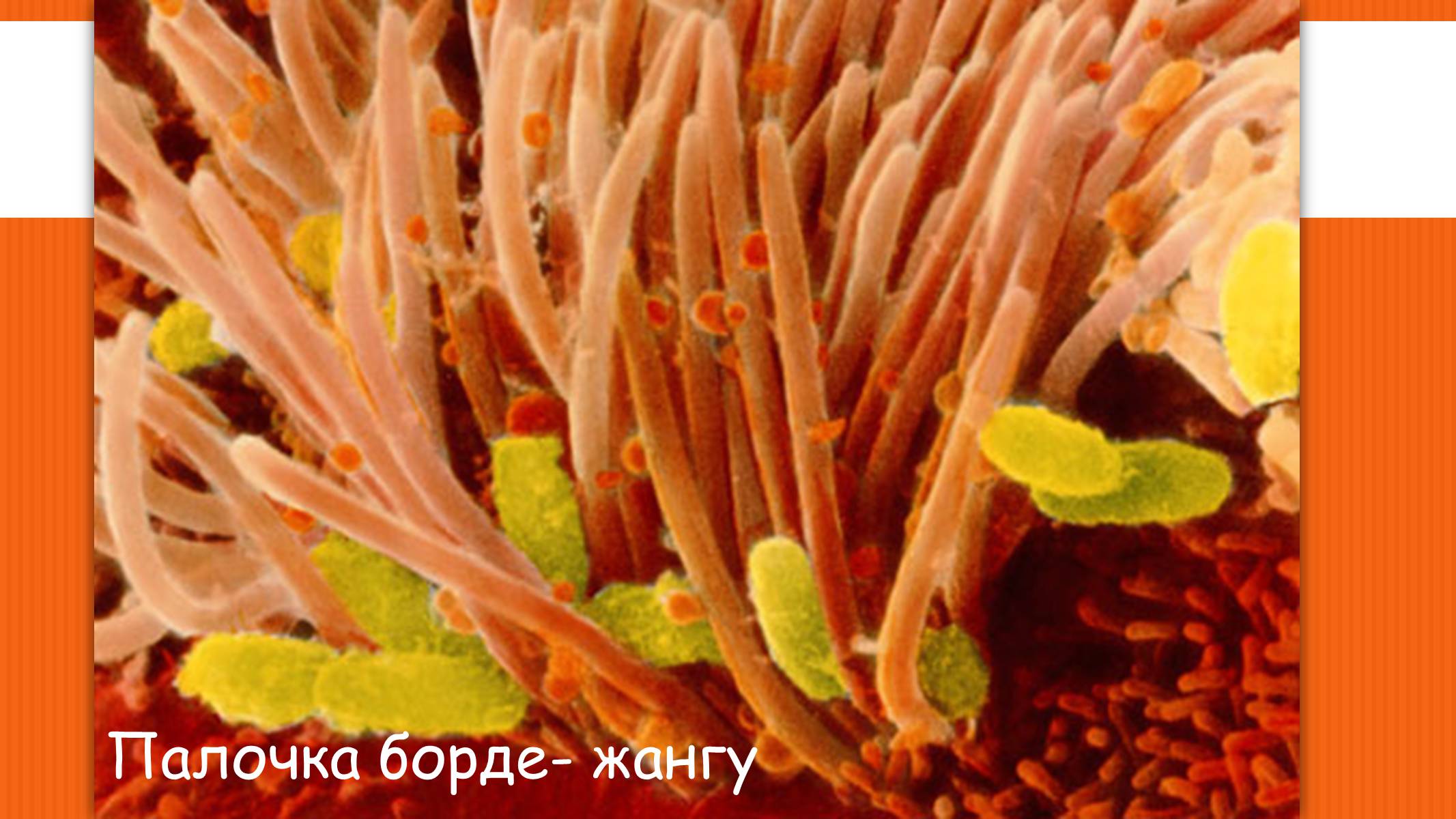 Презентація на тему «Коклюш» - Слайд #4 Презентація на тему «Коклюш» - Слайд #4
