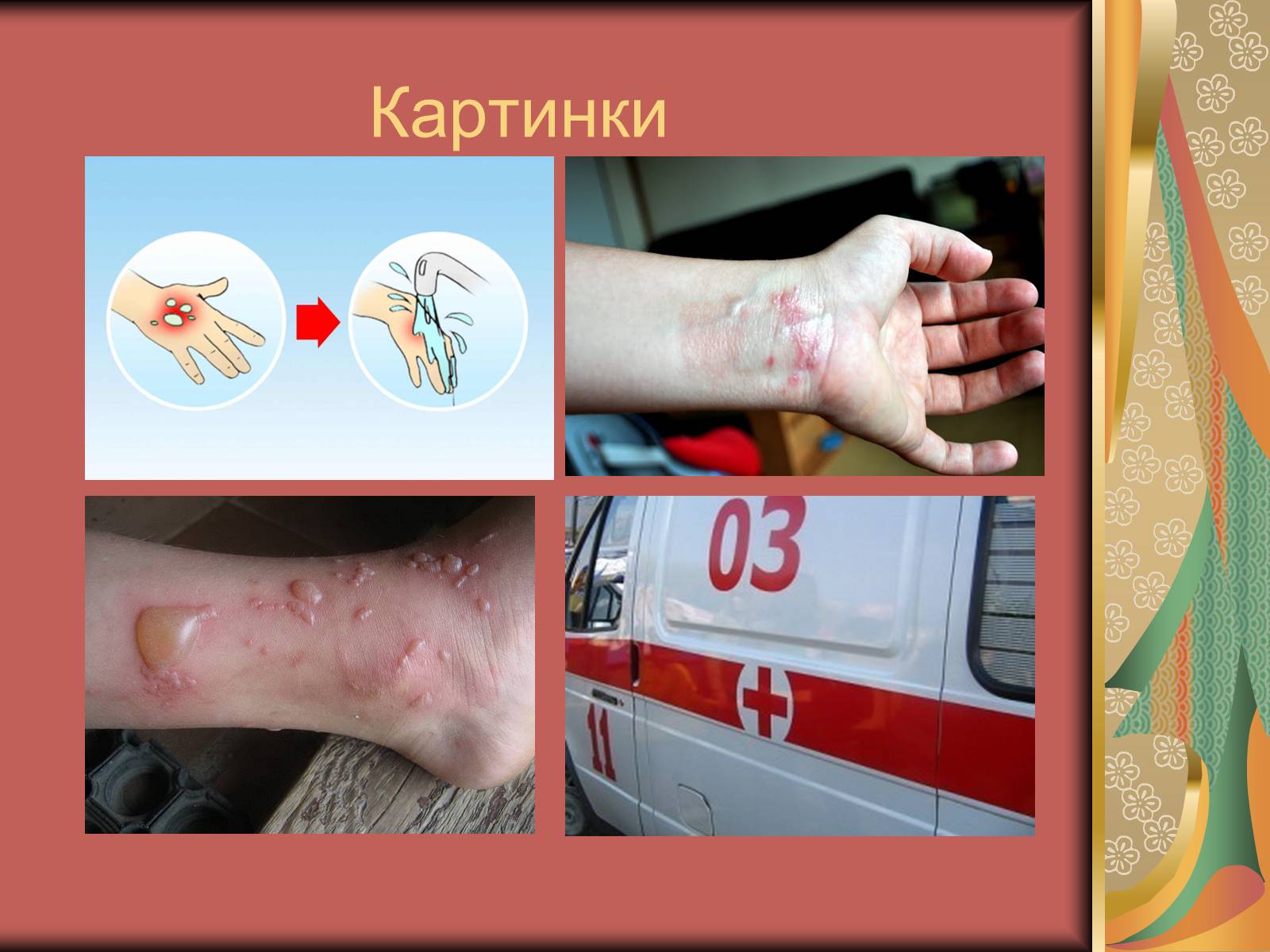Презентація на тему «Перша допомога при опіках» (варіант 1) - Слайд #17 Презентація на тему «Перша допомога при опіках» (варіант 1) - Слайд #17