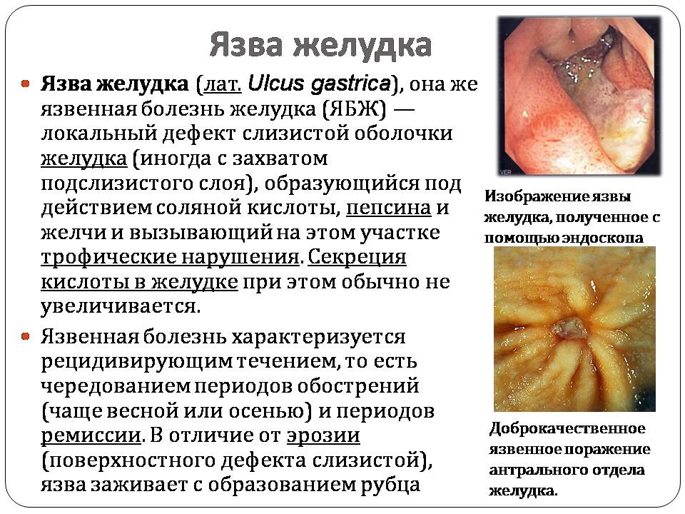 Презентація на тему «Болезни пищеварительной системы» - Слайд #18 Презентація на тему «Болезни пищеварительной системы» - Слайд #18