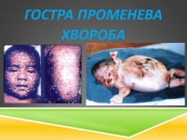 Презентація на тему «Гостра променева хвороба»