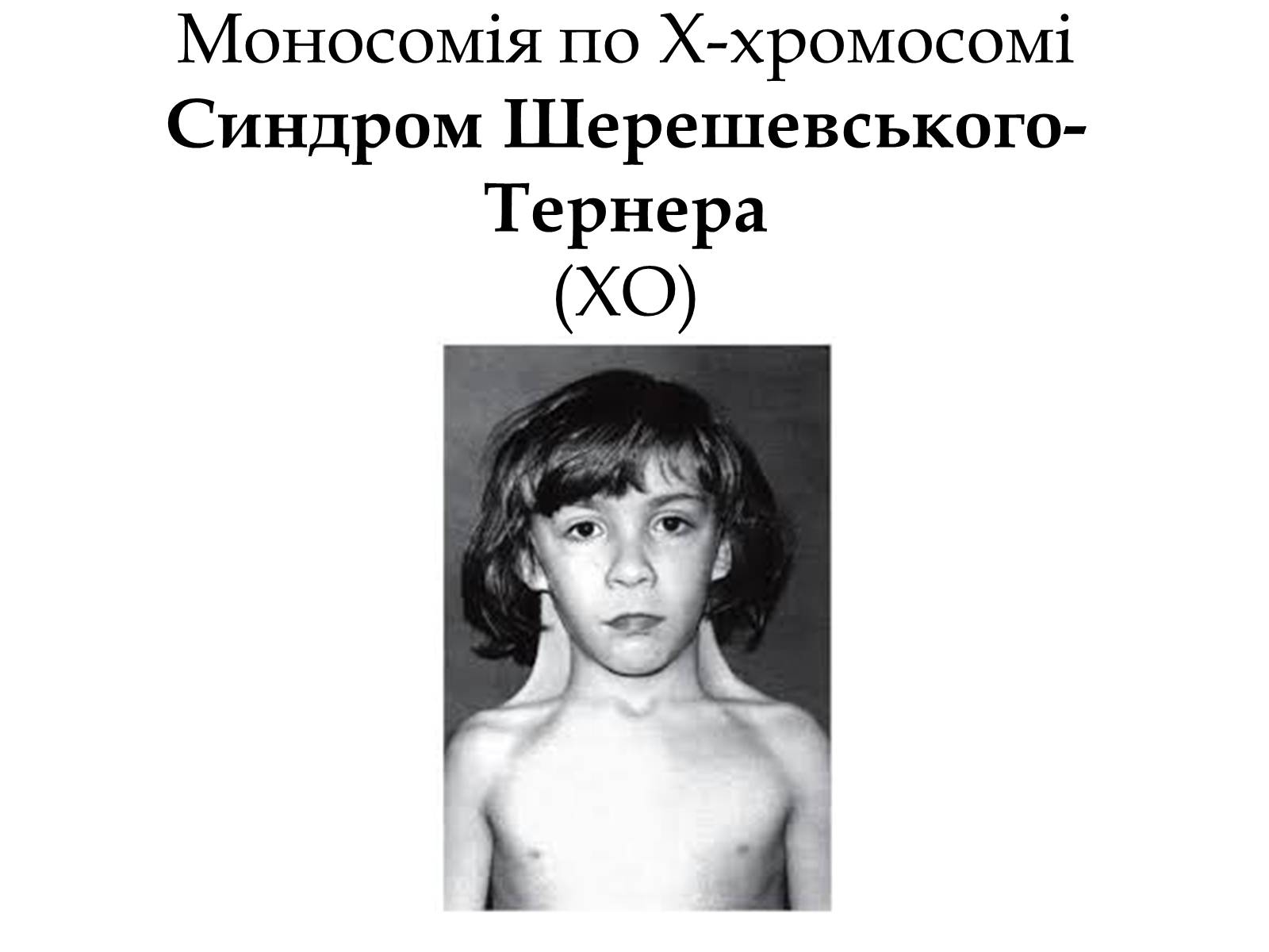 Презентація на тему «Хромосомні хвороби» (варіант 1) - Слайд #10 Презентація на тему «Хромосомні хвороби» (варіант 1) - Слайд #10