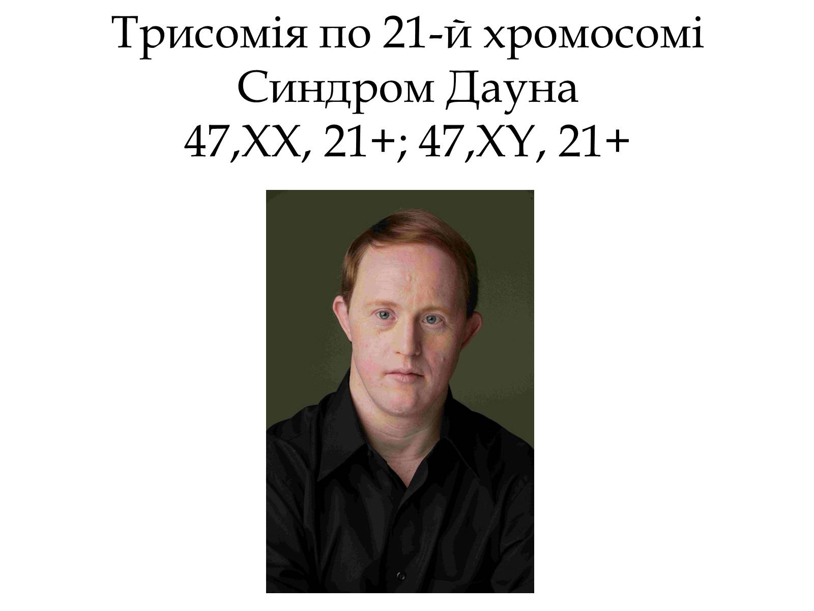 Презентація на тему «Хромосомні хвороби» (варіант 1) - Слайд #8 Презентація на тему «Хромосомні хвороби» (варіант 1) - Слайд #8
