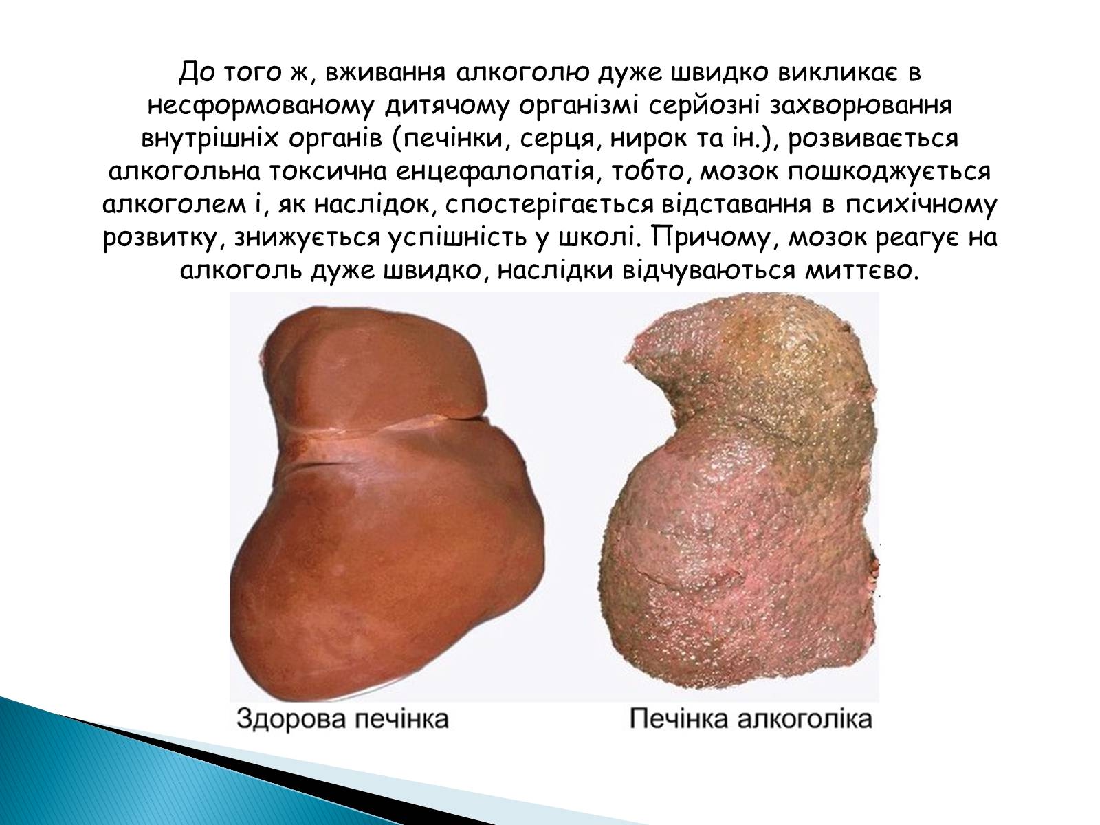 Презентація на тему «Вплив алкоголю на здоров’я підлітка» (варіант 2) - Слайд #10 Презентація на тему «Вплив алкоголю на здоров’я підлітка» (варіант 2) - Слайд #10