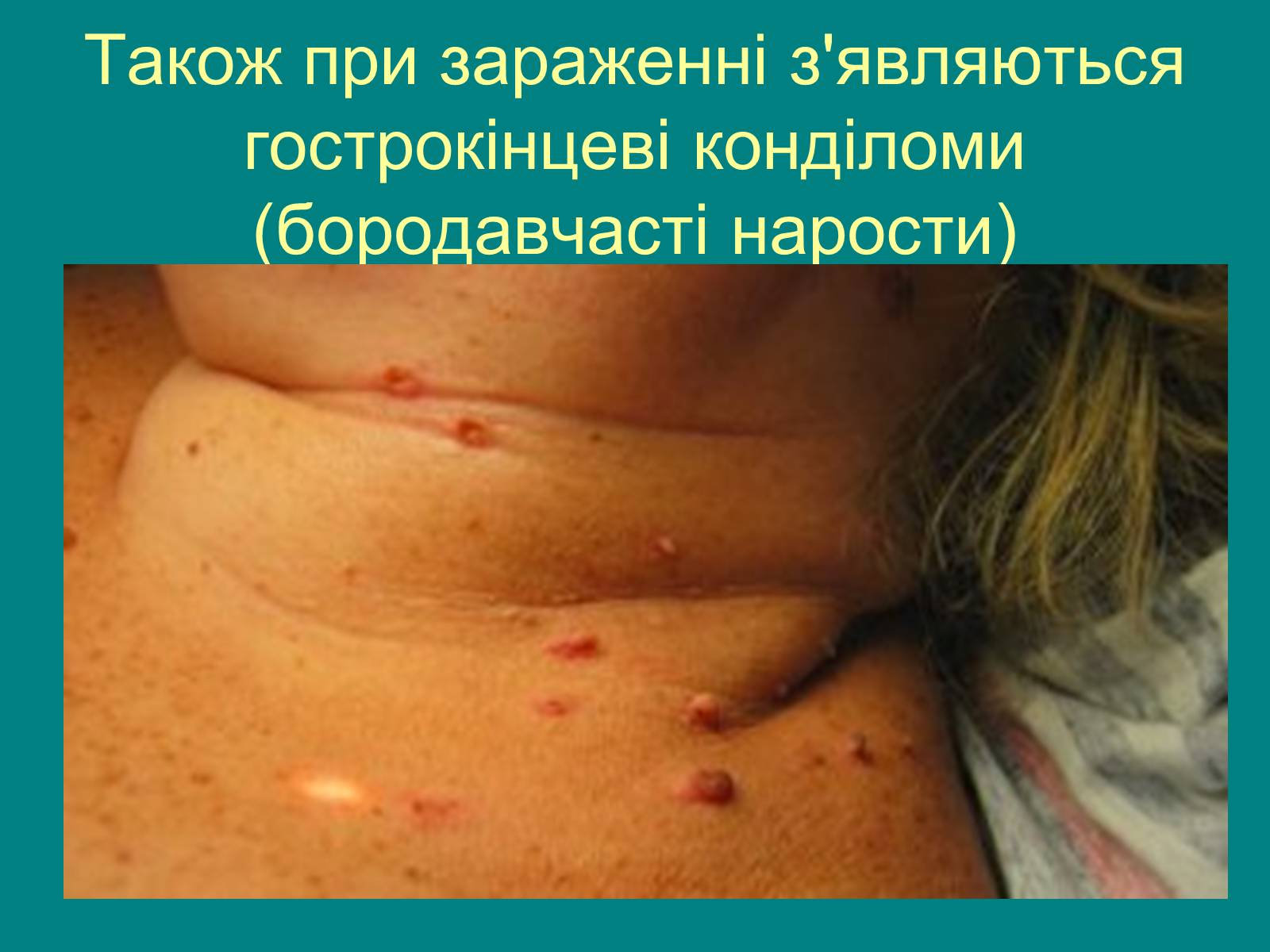 Презентація на тему «Вірус папіломи людини» (варіант 1) - Слайд #8 Презентація на тему «Вірус папіломи людини» (варіант 1) - Слайд #8