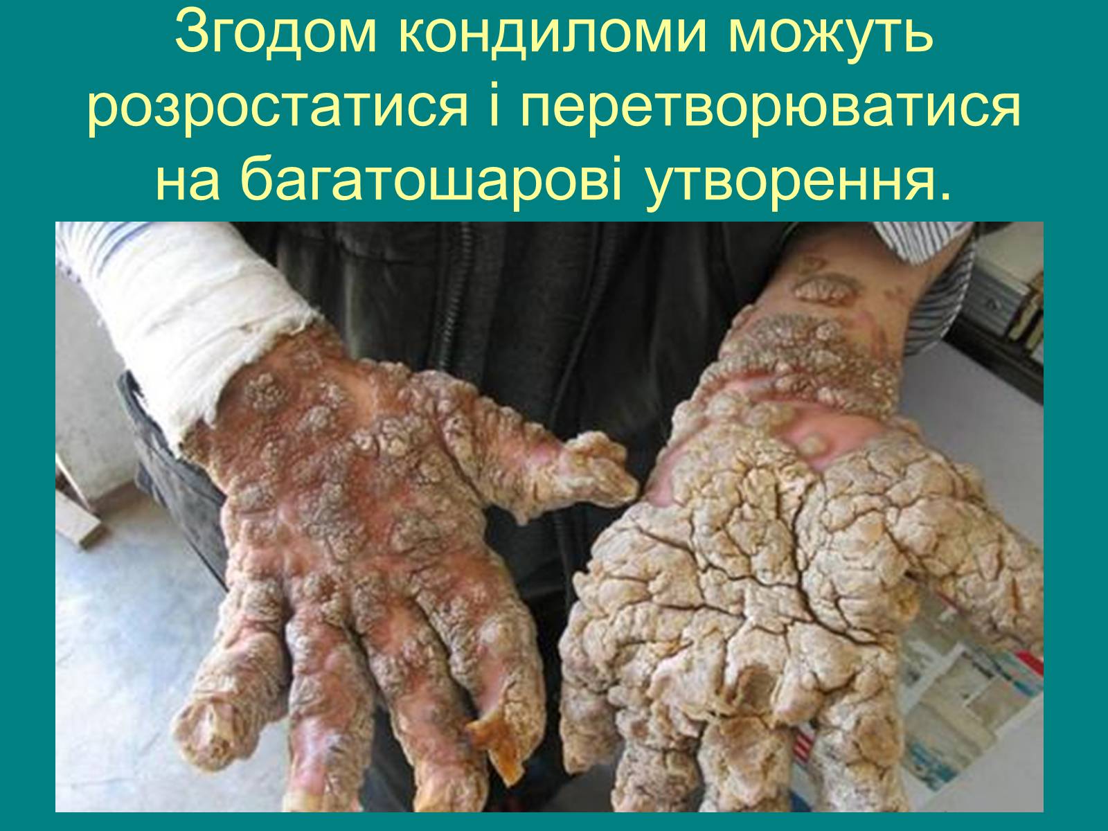 Презентація на тему «Вірус папіломи людини» (варіант 1) - Слайд #9 Презентація на тему «Вірус папіломи людини» (варіант 1) - Слайд #9