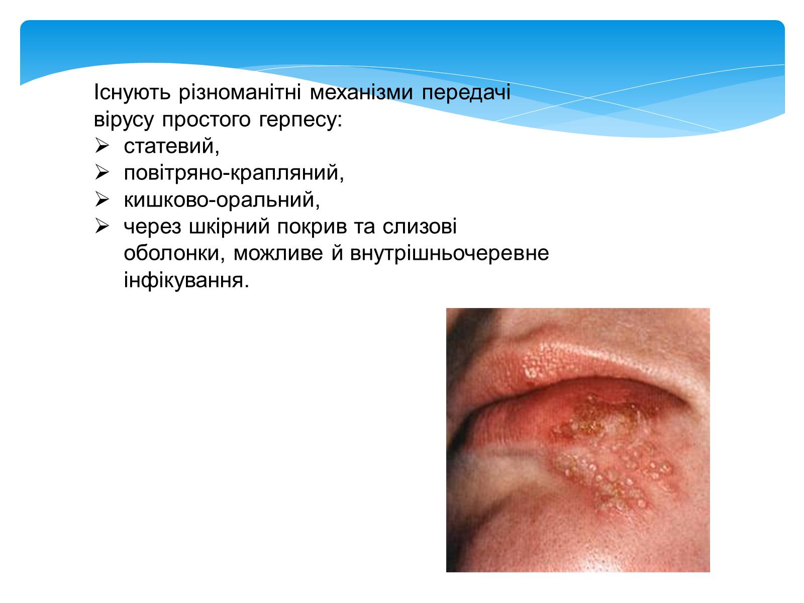 Презентація на тему «Інфекційні захворювання» (варіант 5) - Слайд #13 Презентація на тему «Інфекційні захворювання» (варіант 5) - Слайд #13