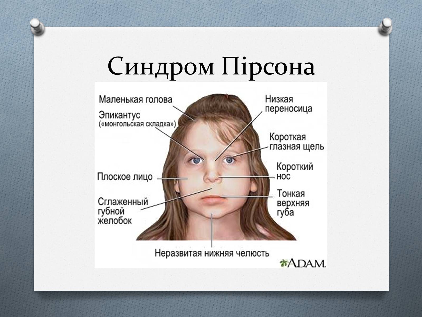Презентація на тему «Генетичні хвороби» - Слайд #15 Презентація на тему «Генетичні хвороби» - Слайд #15