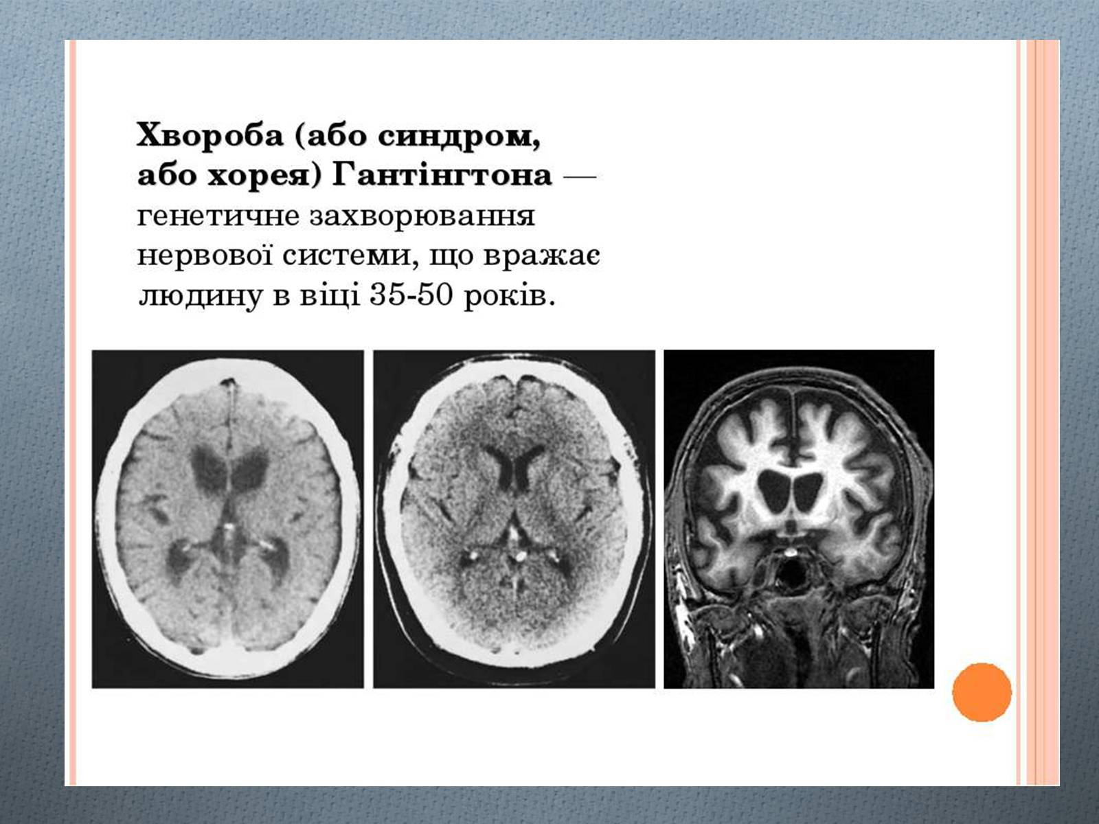 Презентація на тему «Генетичні хвороби» - Слайд #7 Презентація на тему «Генетичні хвороби» - Слайд #7