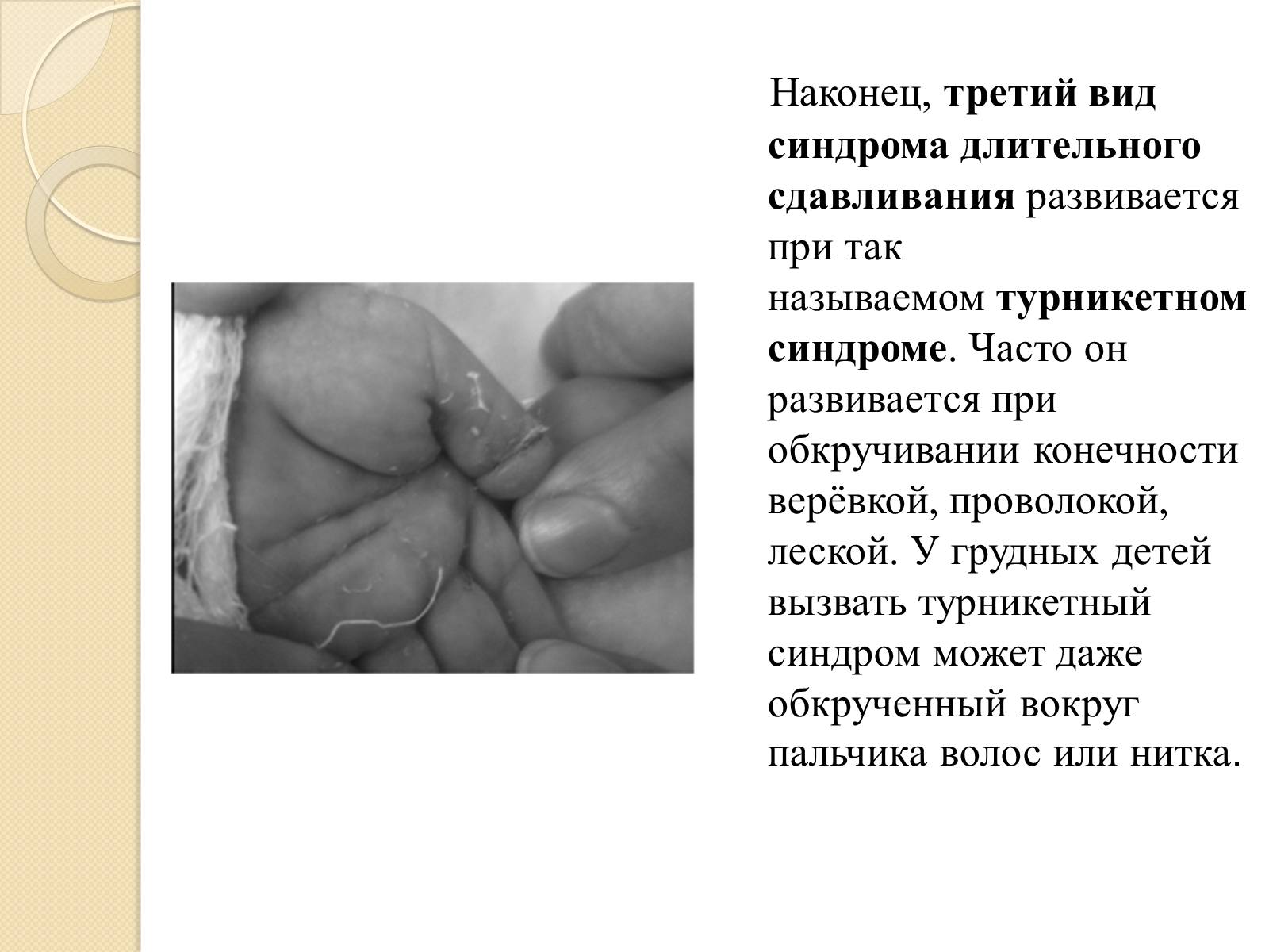 Презентація на тему «Синдром длительного сдавливания» - Слайд #7 Презентація на тему «Синдром длительного сдавливания» - Слайд #7