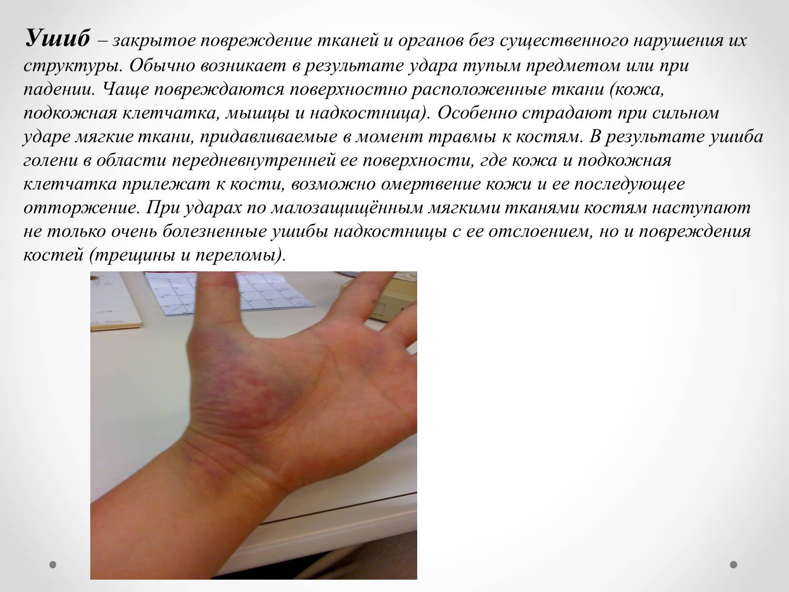 Презентація на тему «Первая помощь при ушибах, растяжениях, переломах» - Слайд #2 Презентація на тему «Первая помощь при ушибах, растяжениях, переломах» - Слайд #2