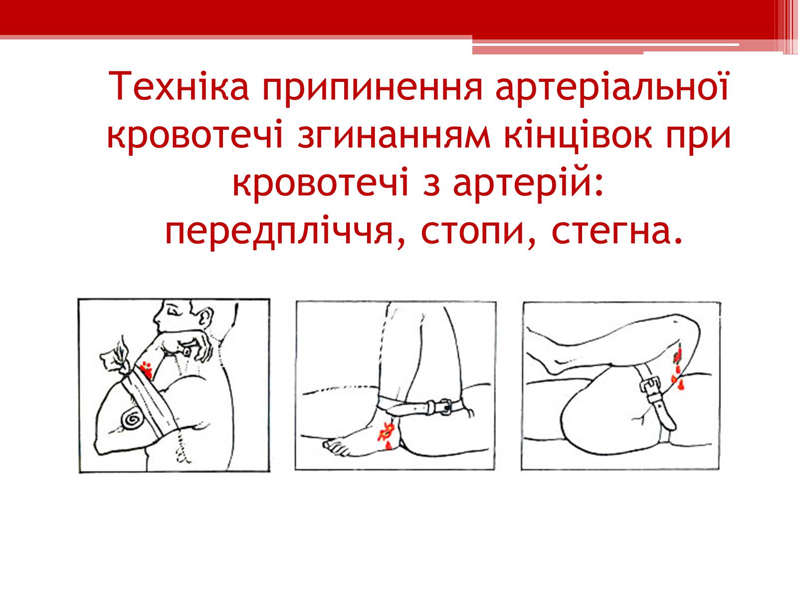Презентація на тему «Перша допомога при кровотечах» (варіант 1) - Слайд #12 Презентація на тему «Перша допомога при кровотечах» (варіант 1) - Слайд #12