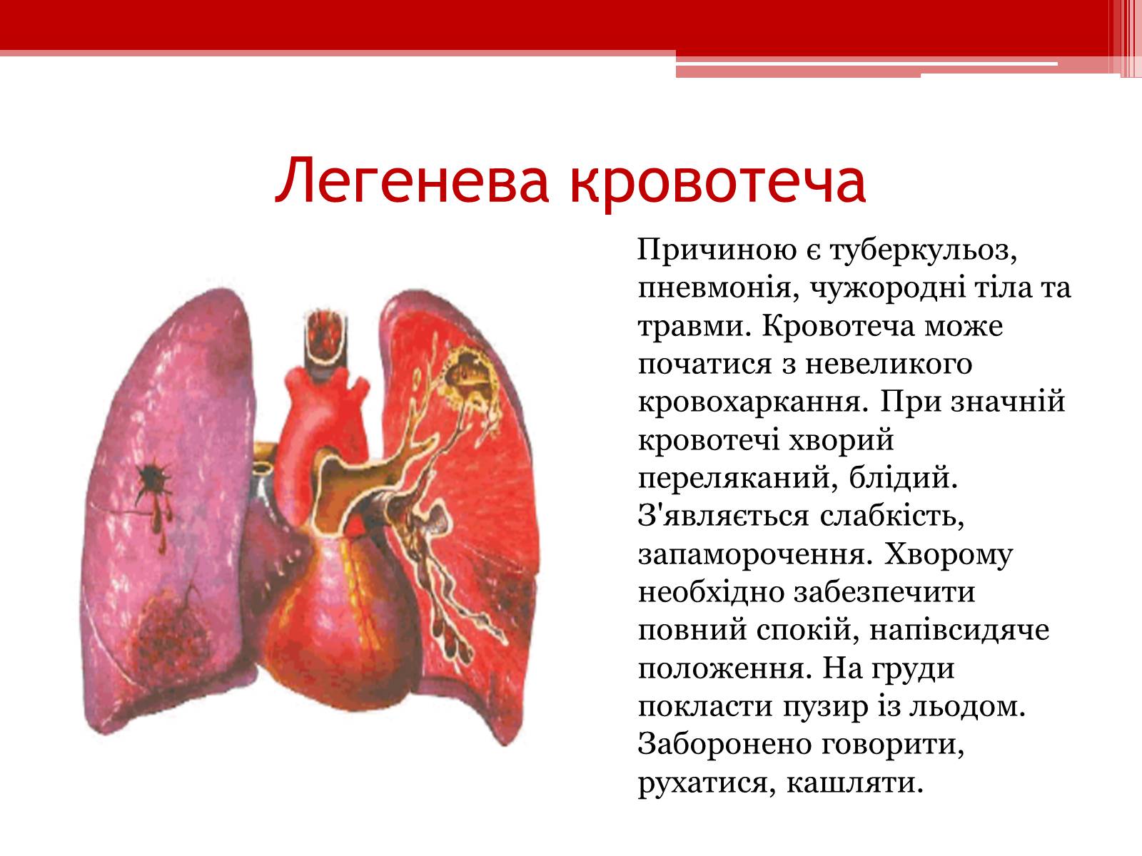 Презентація на тему «Перша допомога при кровотечах» (варіант 1) - Слайд #18 Презентація на тему «Перша допомога при кровотечах» (варіант 1) - Слайд #18