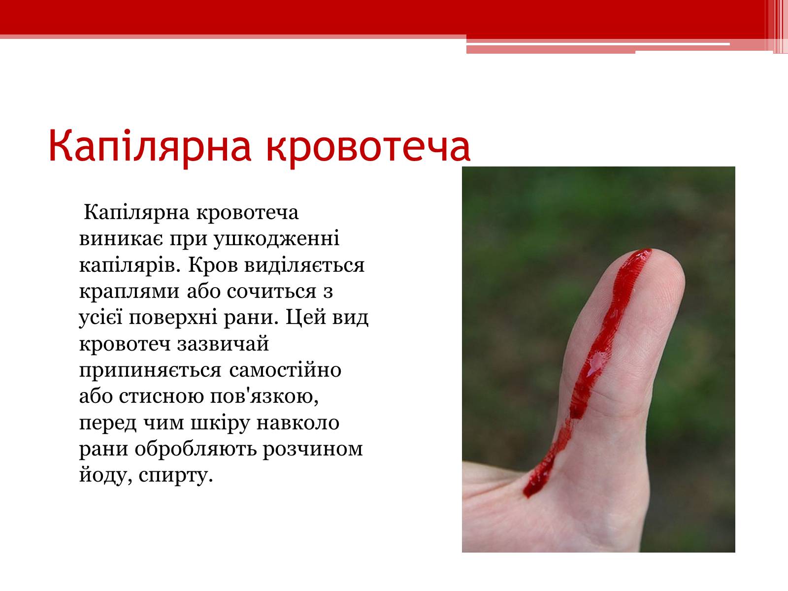 Презентація на тему «Перша допомога при кровотечах» (варіант 1) - Слайд #5 Презентація на тему «Перша допомога при кровотечах» (варіант 1) - Слайд #5