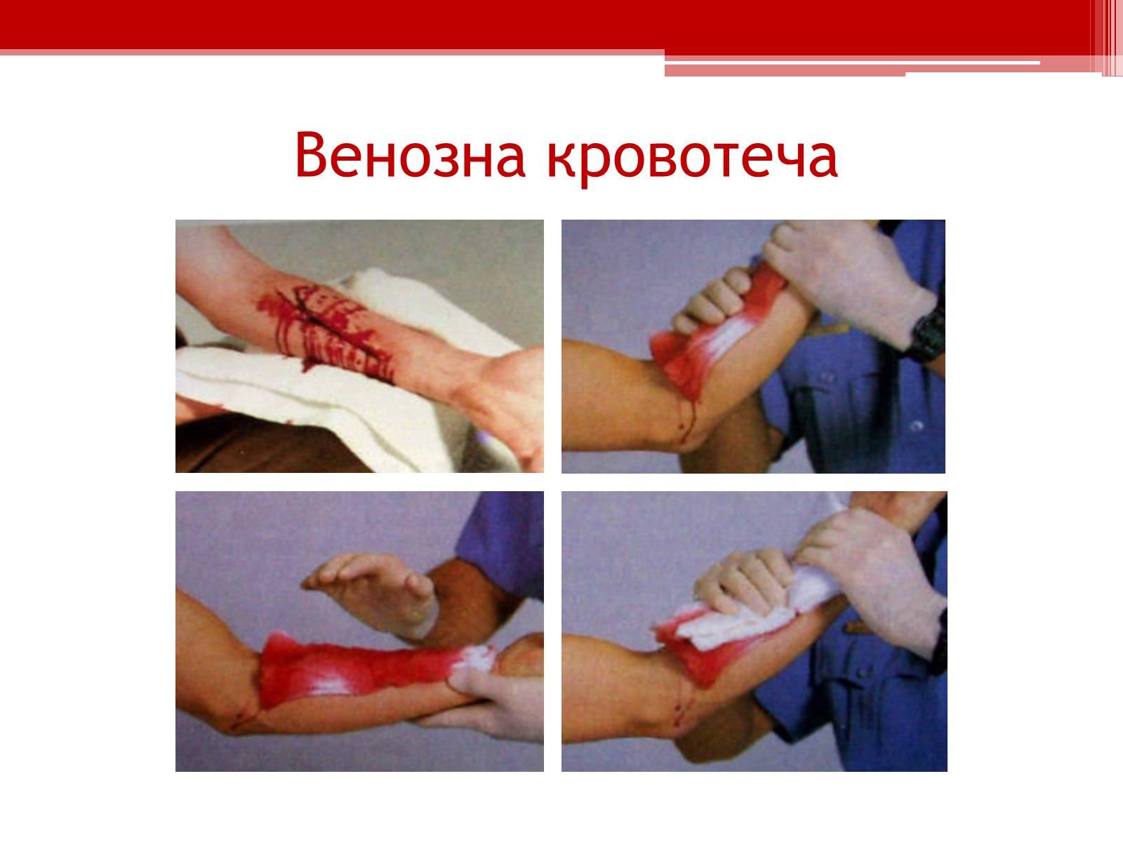 Презентація на тему «Перша допомога при кровотечах» (варіант 1) - Слайд #7 Презентація на тему «Перша допомога при кровотечах» (варіант 1) - Слайд #7