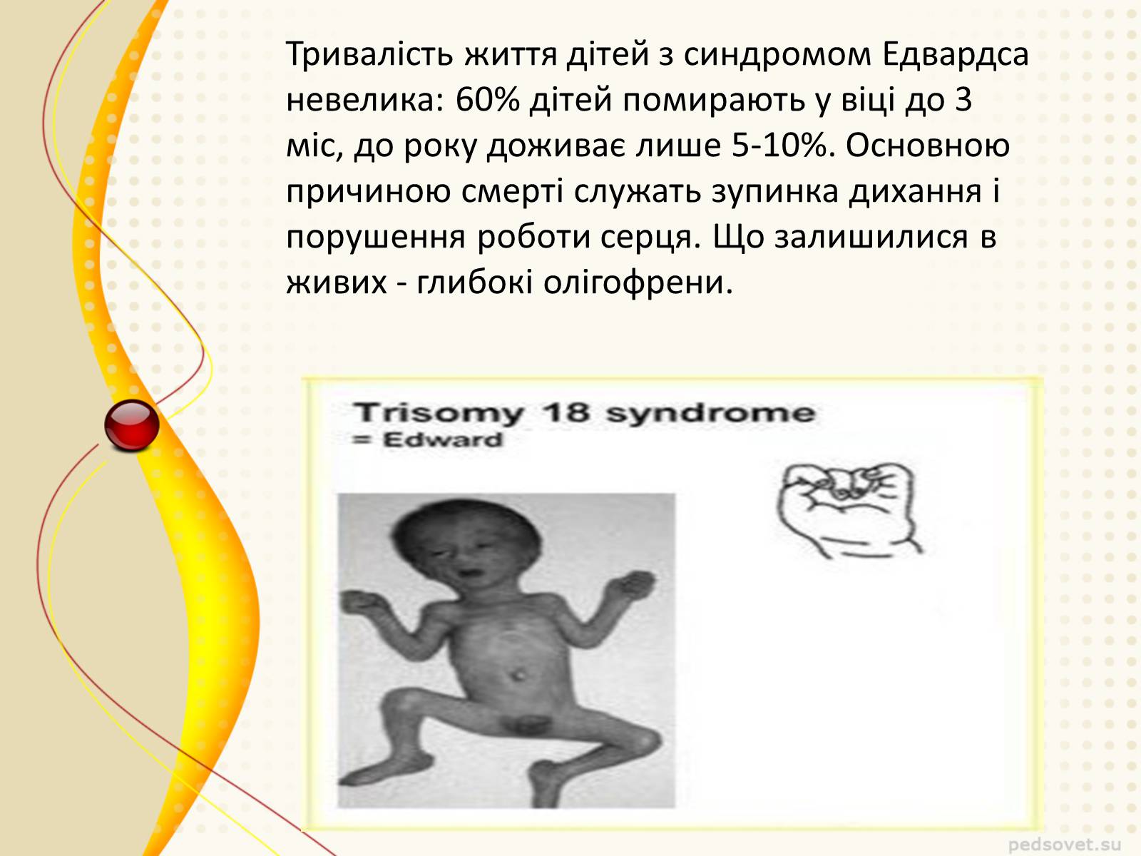 Презентація на тему «Синдром Эдвардса» - Слайд #6 Презентація на тему «Синдром Эдвардса» - Слайд #6