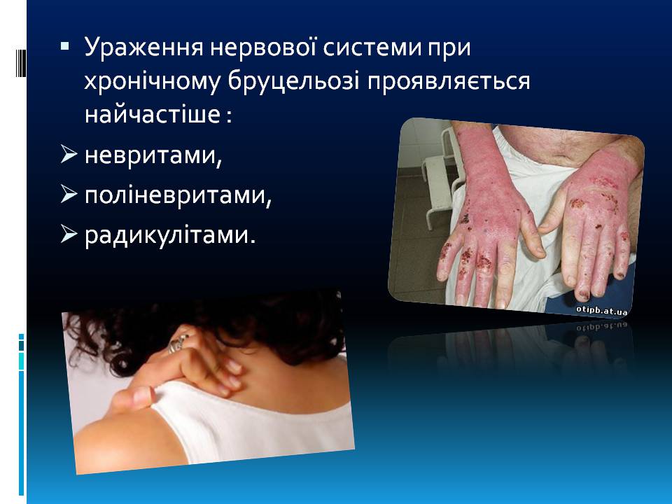 Презентація на тему «Бруцельоз» - Слайд #13 Презентація на тему «Бруцельоз» - Слайд #13