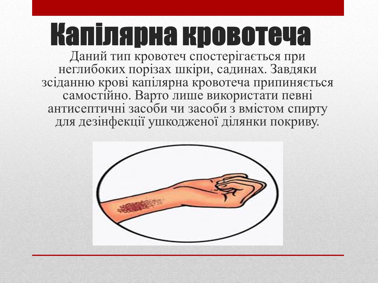 Презентація на тему «Кровотечі» (варіант 1) - Слайд #5 Презентація на тему «Кровотечі» (варіант 1) - Слайд #5