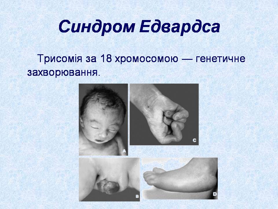 Презентація на тему «Геномні порушення» - Слайд #16 Презентація на тему «Геномні порушення» - Слайд #16