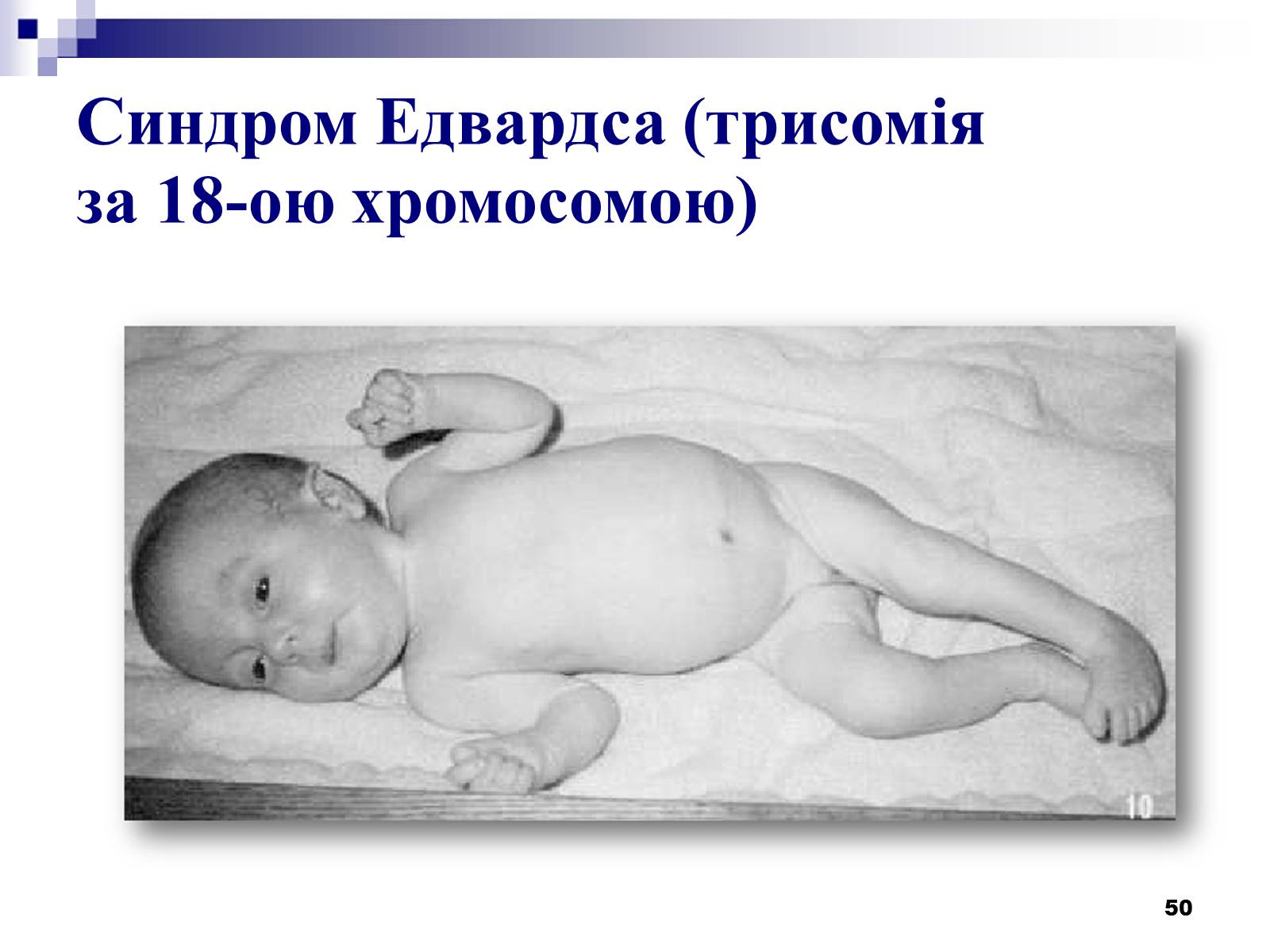 Презентація на тему «Хромосомні хвороби» (варіант 2) - Слайд #19 Презентація на тему «Хромосомні хвороби» (варіант 2) - Слайд #19