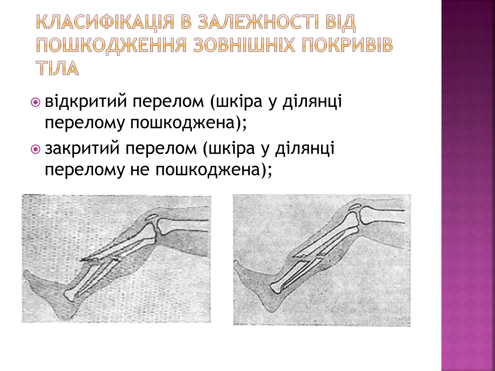 Презентація на тему «Переломи і вивихи» (варіант 4) - Слайд #3 Презентація на тему «Переломи і вивихи» (варіант 4) - Слайд #3