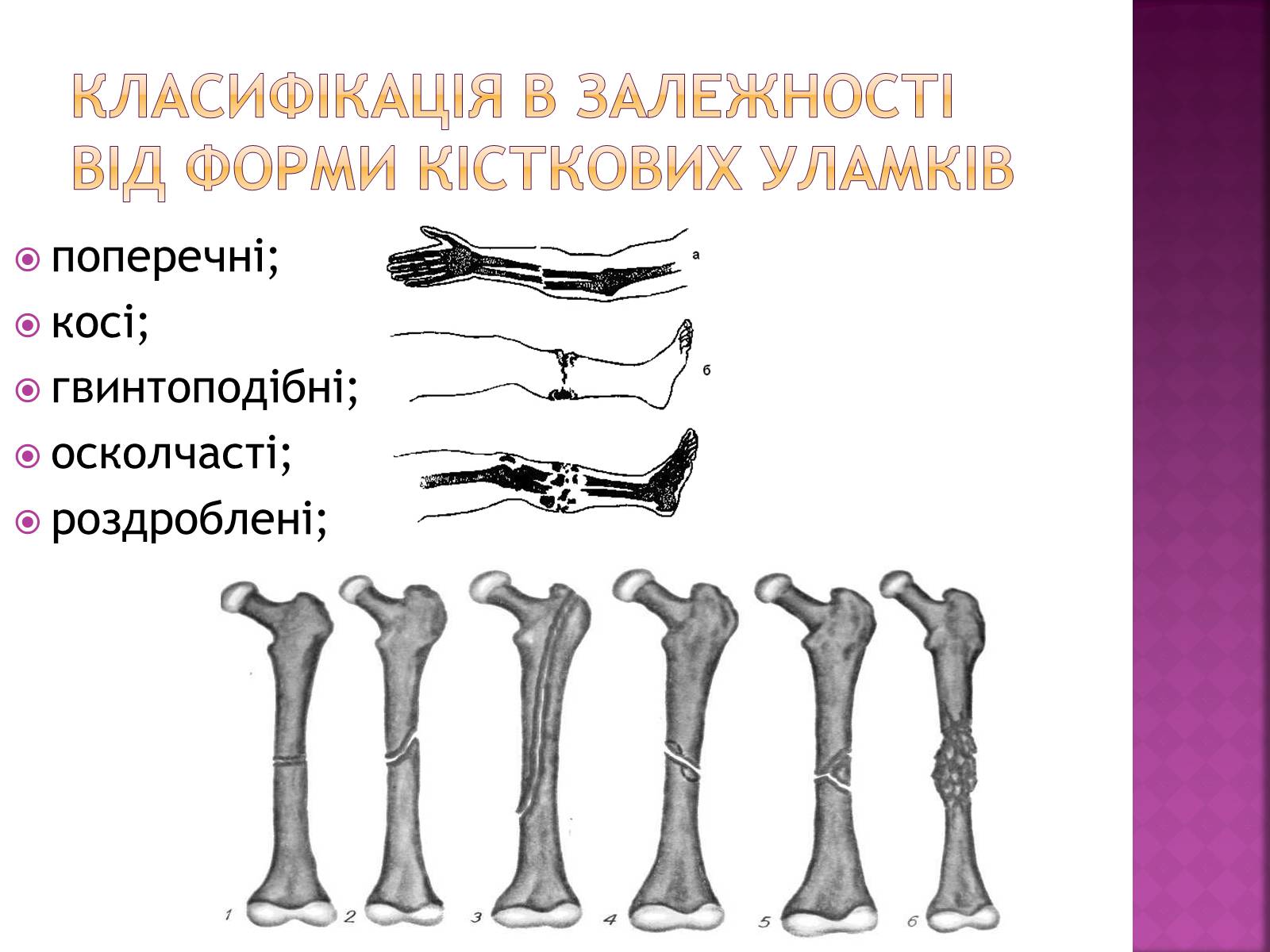 Презентація на тему «Переломи і вивихи» (варіант 4) - Слайд #4 Презентація на тему «Переломи і вивихи» (варіант 4) - Слайд #4