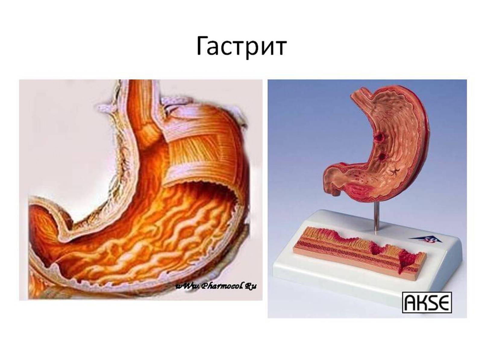 Презентація на тему «Гастрит» - Слайд #3 Презентація на тему «Гастрит» - Слайд #3