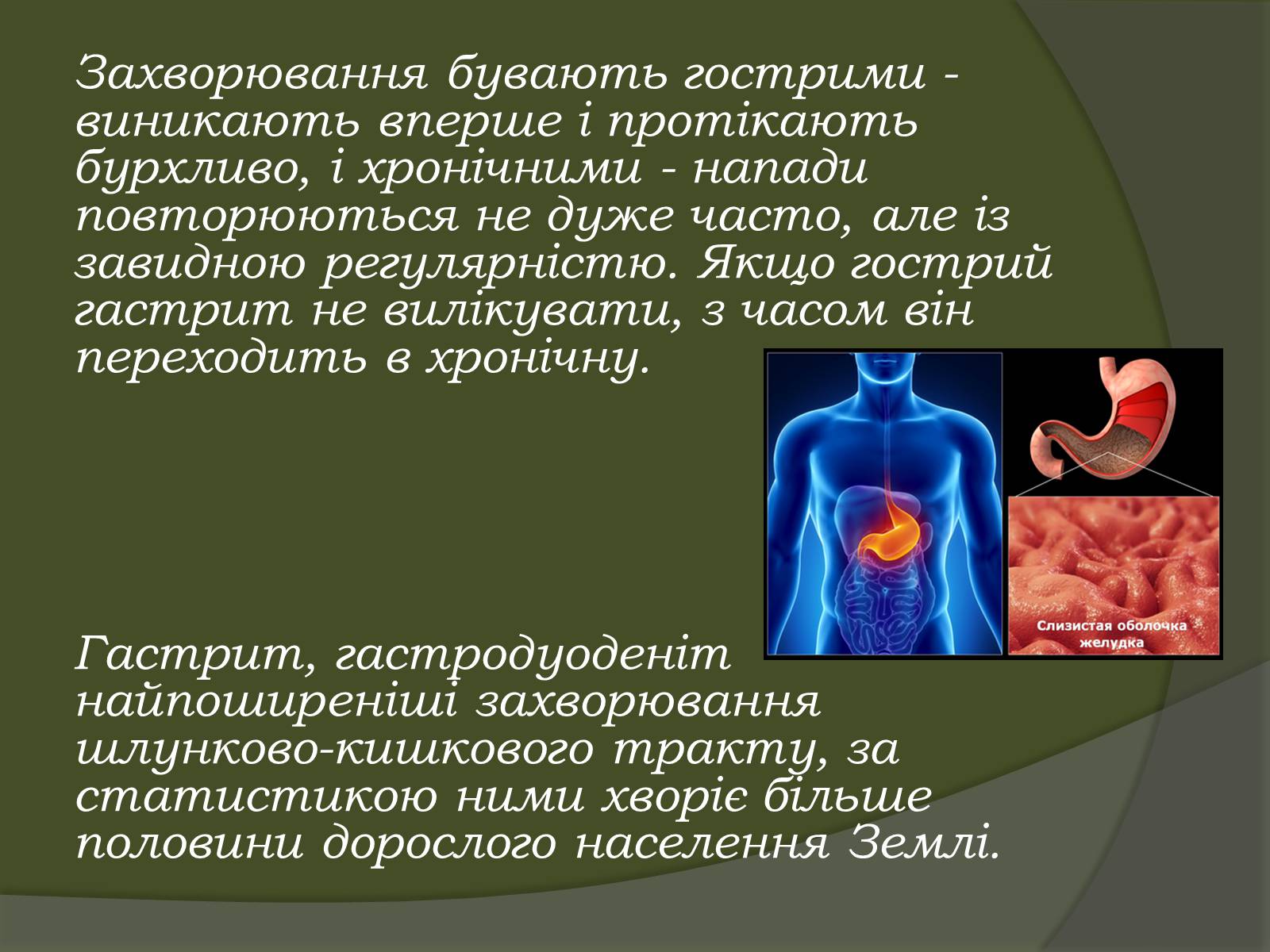 Презентація на тему «Гастрит» - Слайд #4 Презентація на тему «Гастрит» - Слайд #4