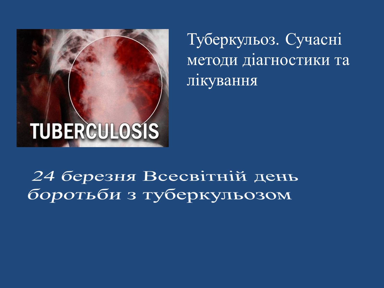 Презентація на тему «Туберкульоз. Сучасні методи діагностики та лікування» - Слайд #1 Презентація на тему «Туберкульоз. Сучасні методи діагностики та лікування» - Слайд #1