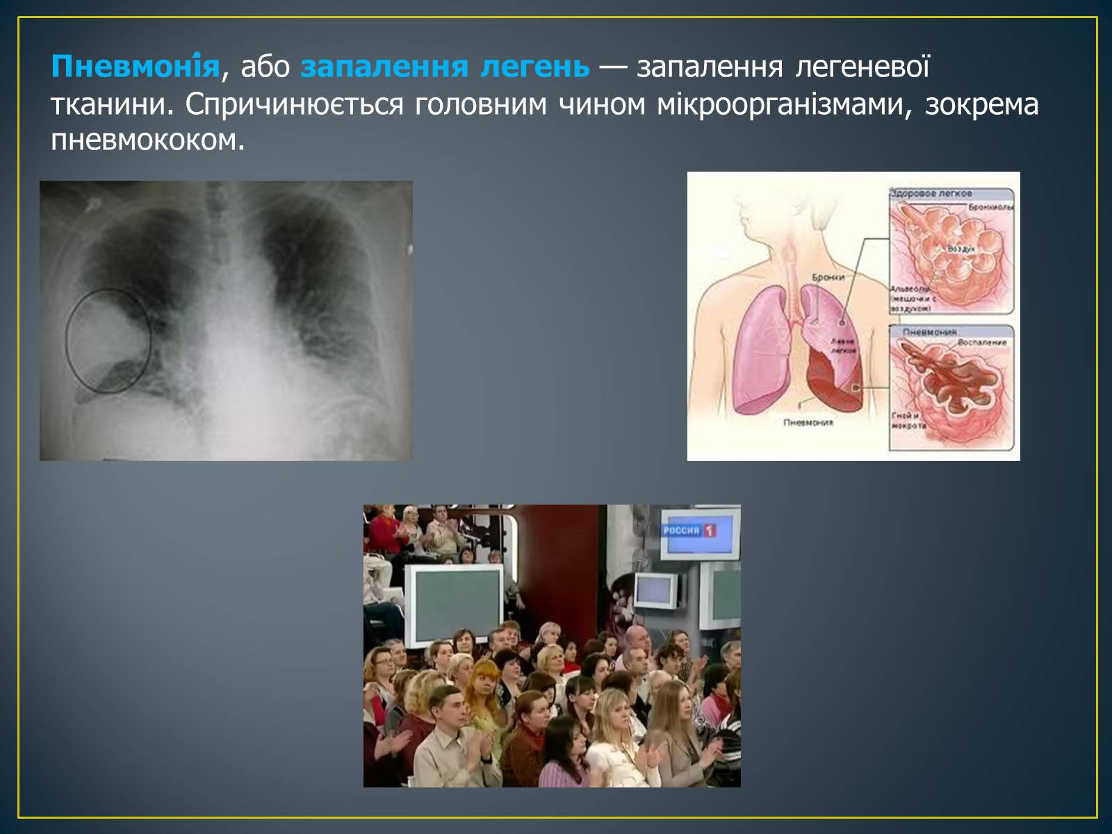 Презентація на тему «Захворювання органів дихання» - Слайд #10 Презентація на тему «Захворювання органів дихання» - Слайд #10