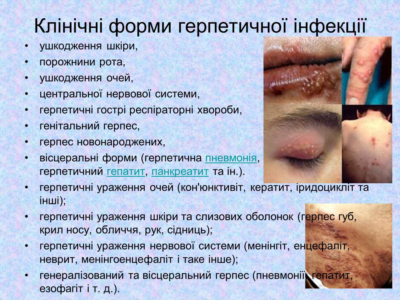 Презентація на тему «Вірус Герпесу» - Слайд #11 Презентація на тему «Вірус Герпесу» - Слайд #11