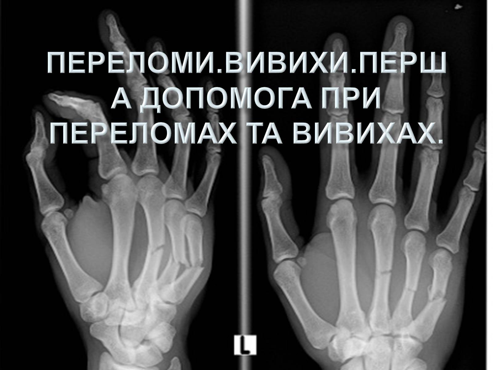 Презентація на тему «Переломи. Вивихи» - Слайд #1 Презентація на тему «Переломи. Вивихи» - Слайд #1