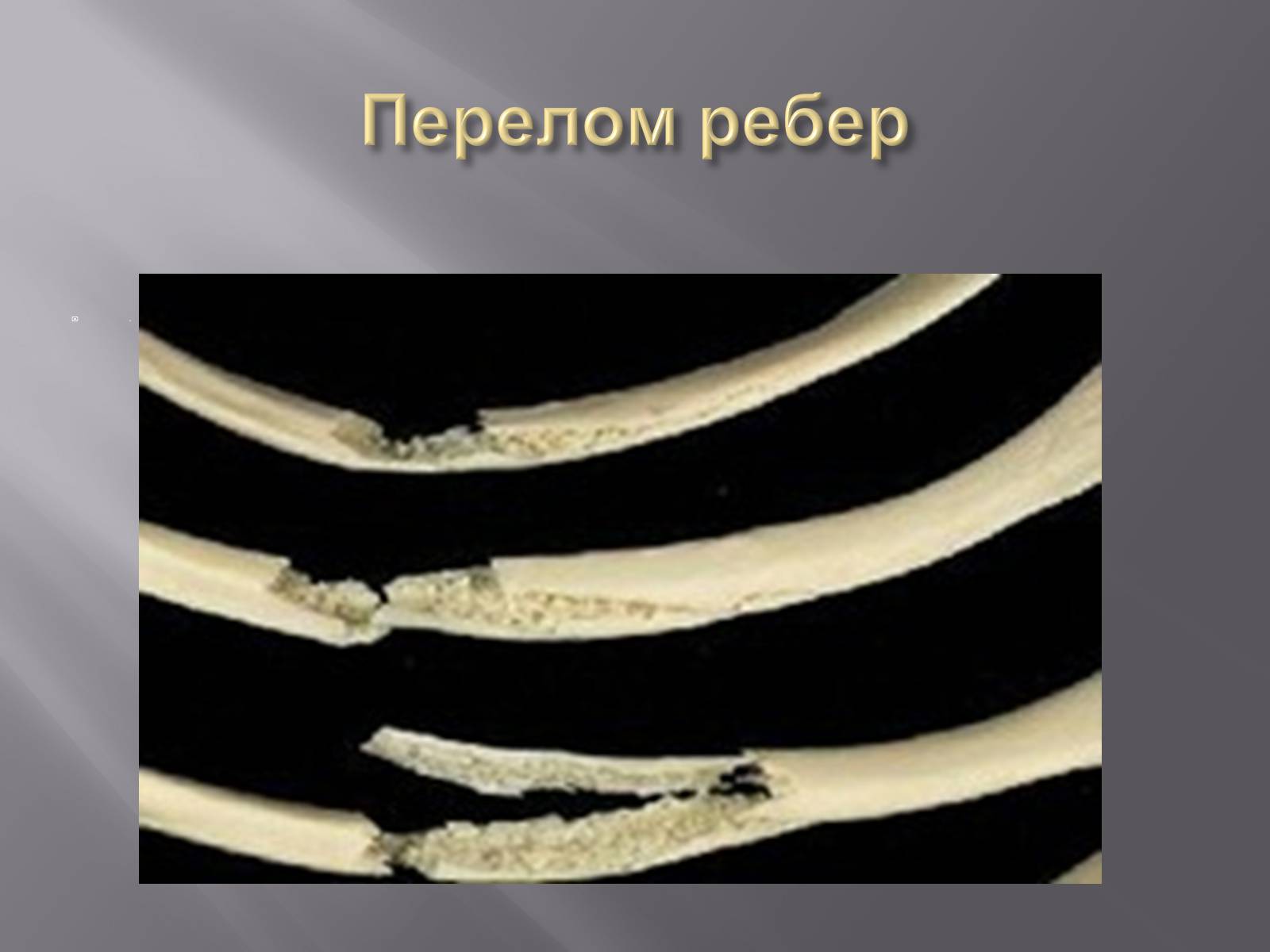 Презентація на тему «Переломи. Вивихи» - Слайд #11 Презентація на тему «Переломи. Вивихи» - Слайд #11