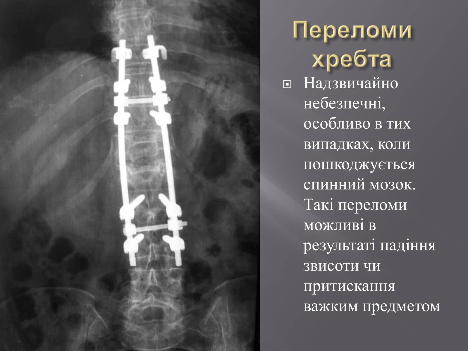 Презентація на тему «Переломи. Вивихи» - Слайд #14 Презентація на тему «Переломи. Вивихи» - Слайд #14