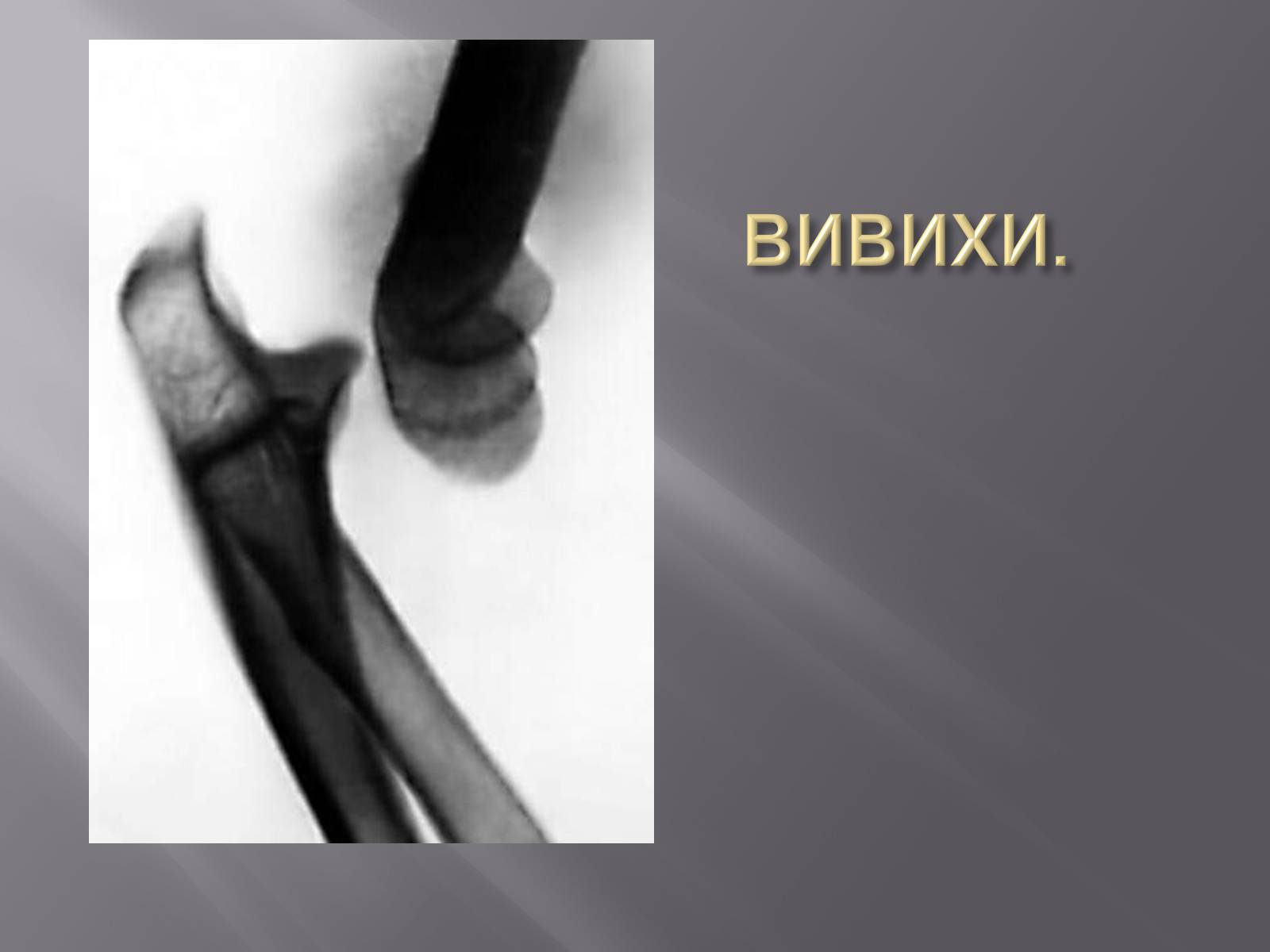 Презентація на тему «Переломи. Вивихи» - Слайд #17 Презентація на тему «Переломи. Вивихи» - Слайд #17
