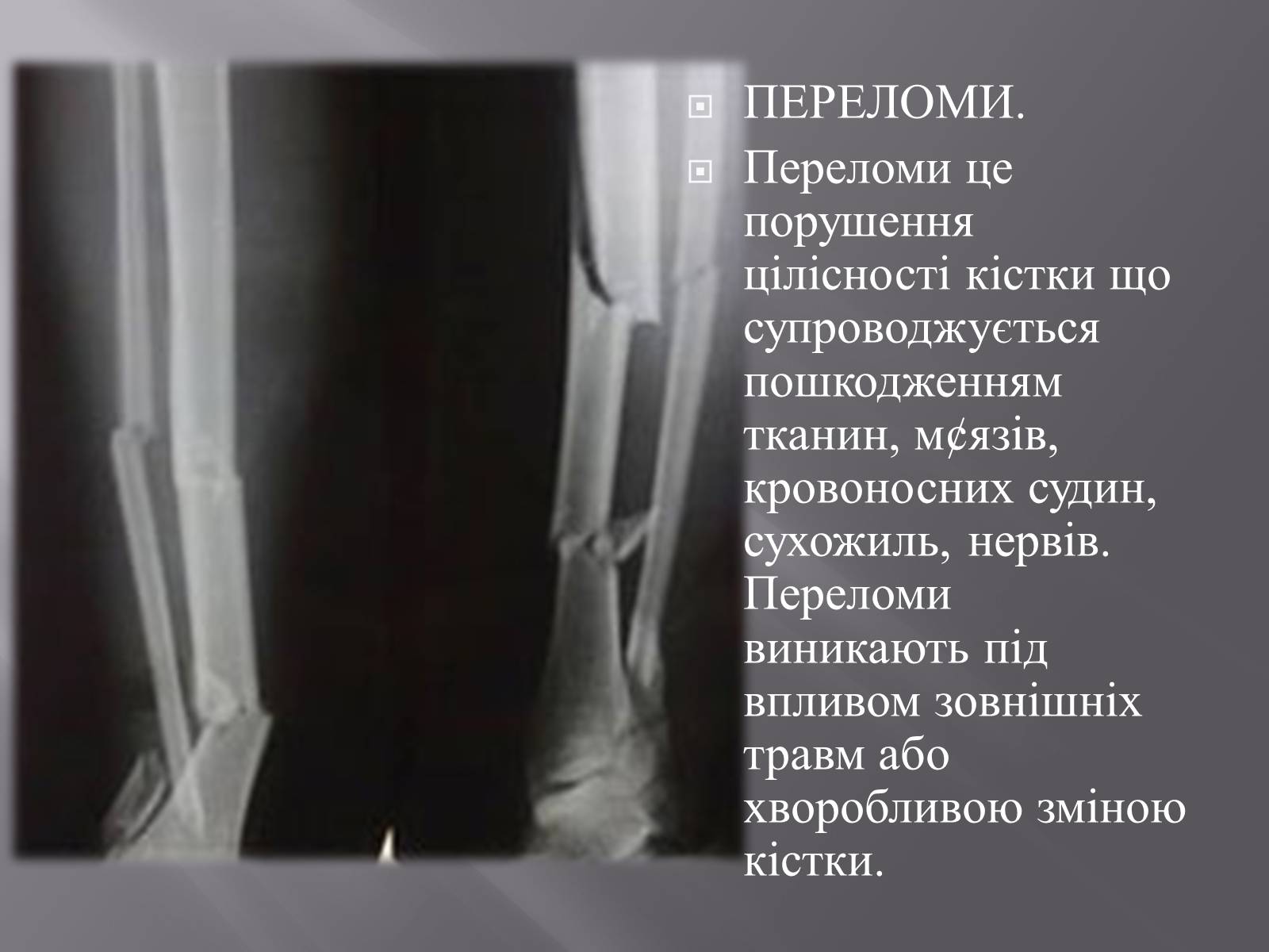 Презентація на тему «Переломи. Вивихи» - Слайд #2 Презентація на тему «Переломи. Вивихи» - Слайд #2