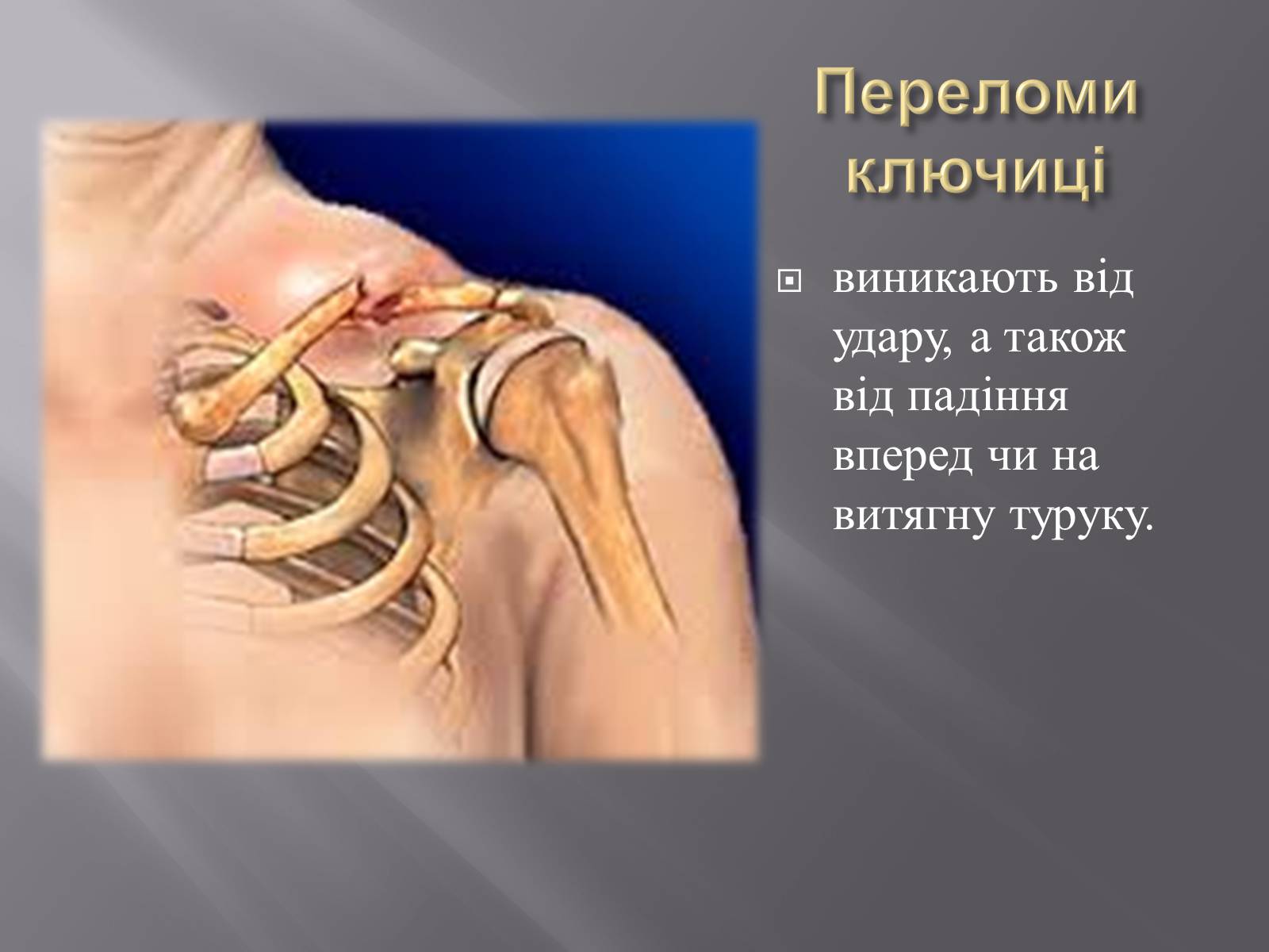 Презентація на тему «Переломи. Вивихи» - Слайд #9 Презентація на тему «Переломи. Вивихи» - Слайд #9