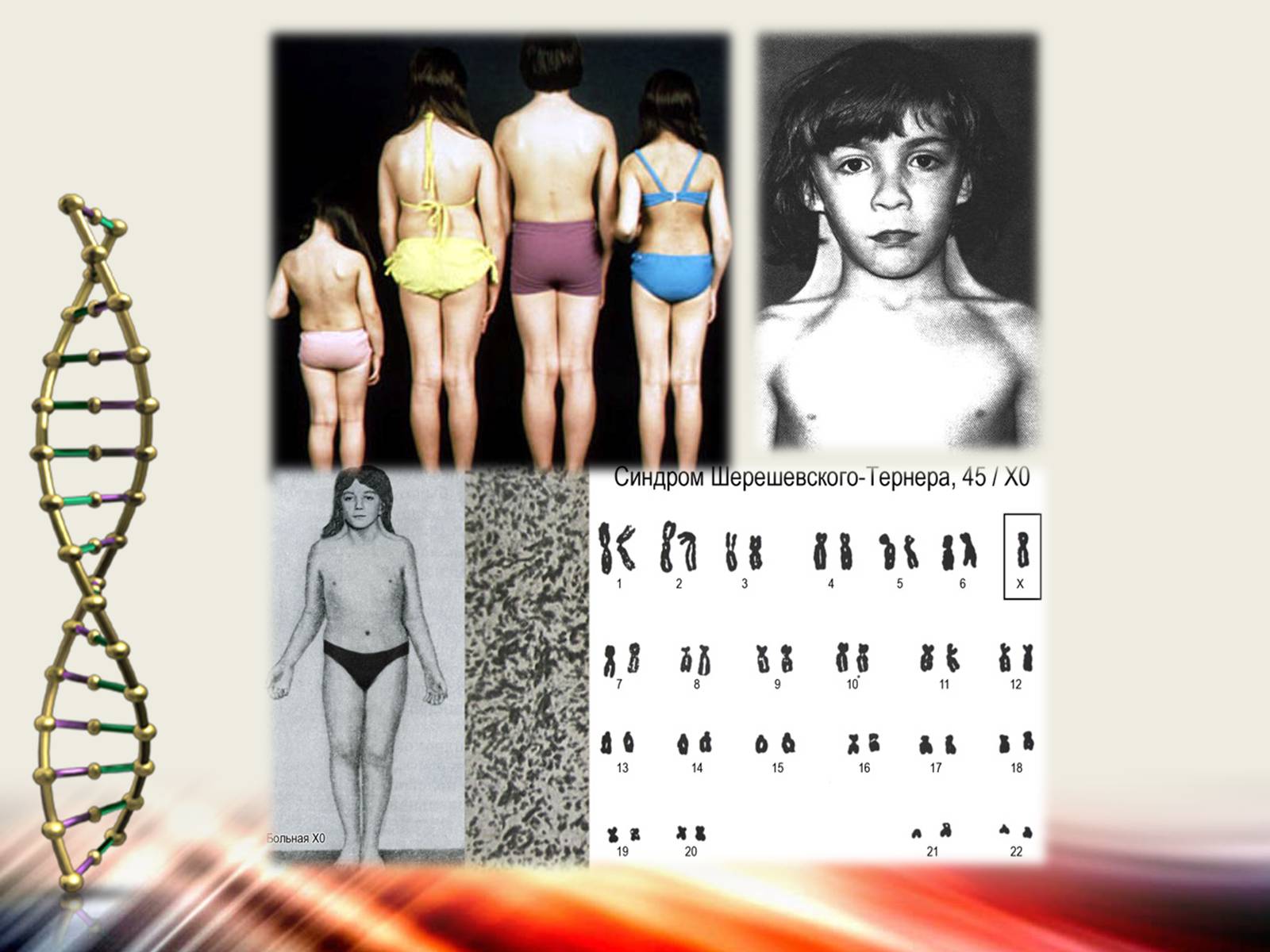Презентація на тему «Генетичні захворювання» (варіант 1) - Слайд #8 Презентація на тему «Генетичні захворювання» (варіант 1) - Слайд #8