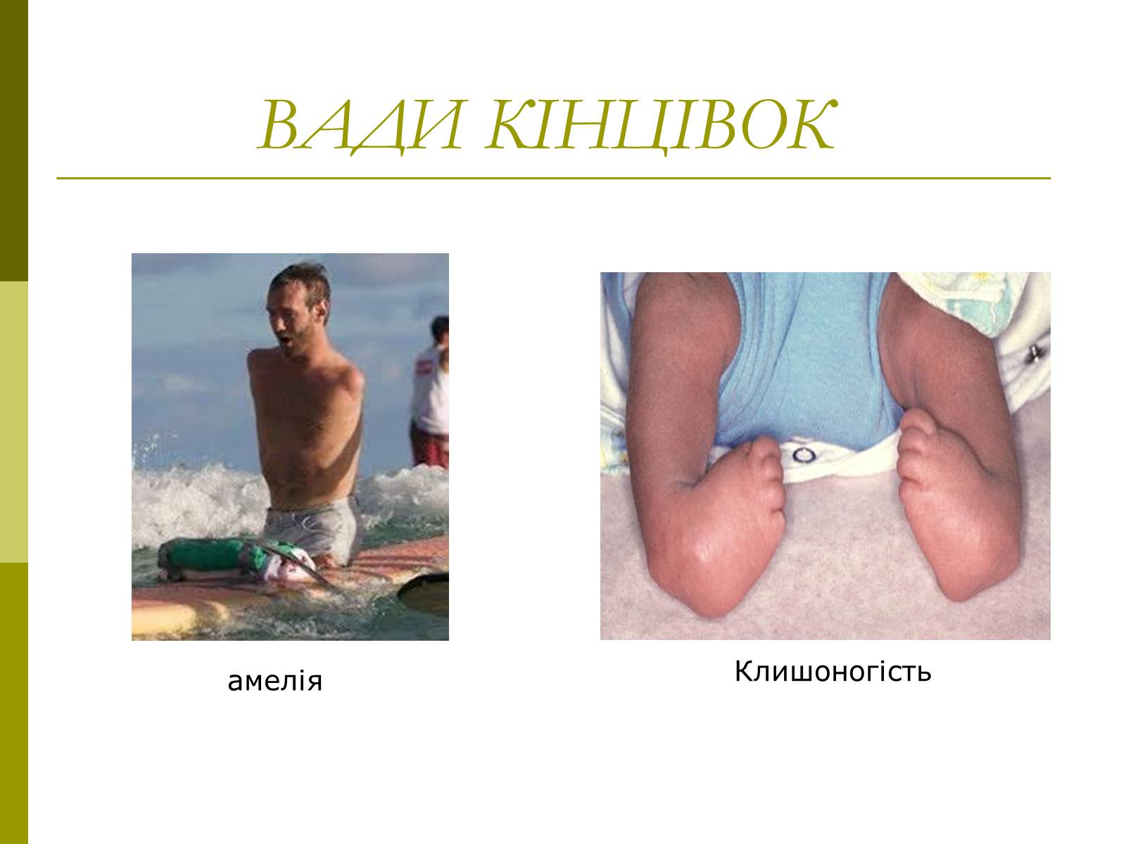Презентація на тему «Вади розвитку організмів» (варіант 1) - Слайд #11 Презентація на тему «Вади розвитку організмів» (варіант 1) - Слайд #11