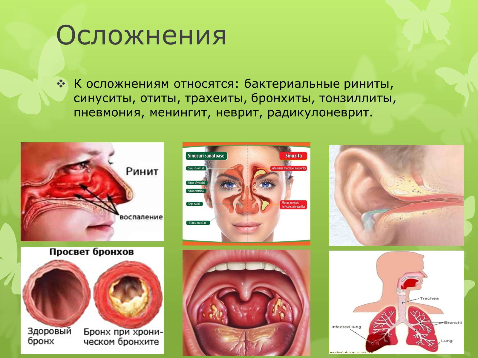 Презентація на тему «Острая респираторная вирусная инфекция» - Слайд #5 Презентація на тему «Острая респираторная вирусная инфекция» - Слайд #5
