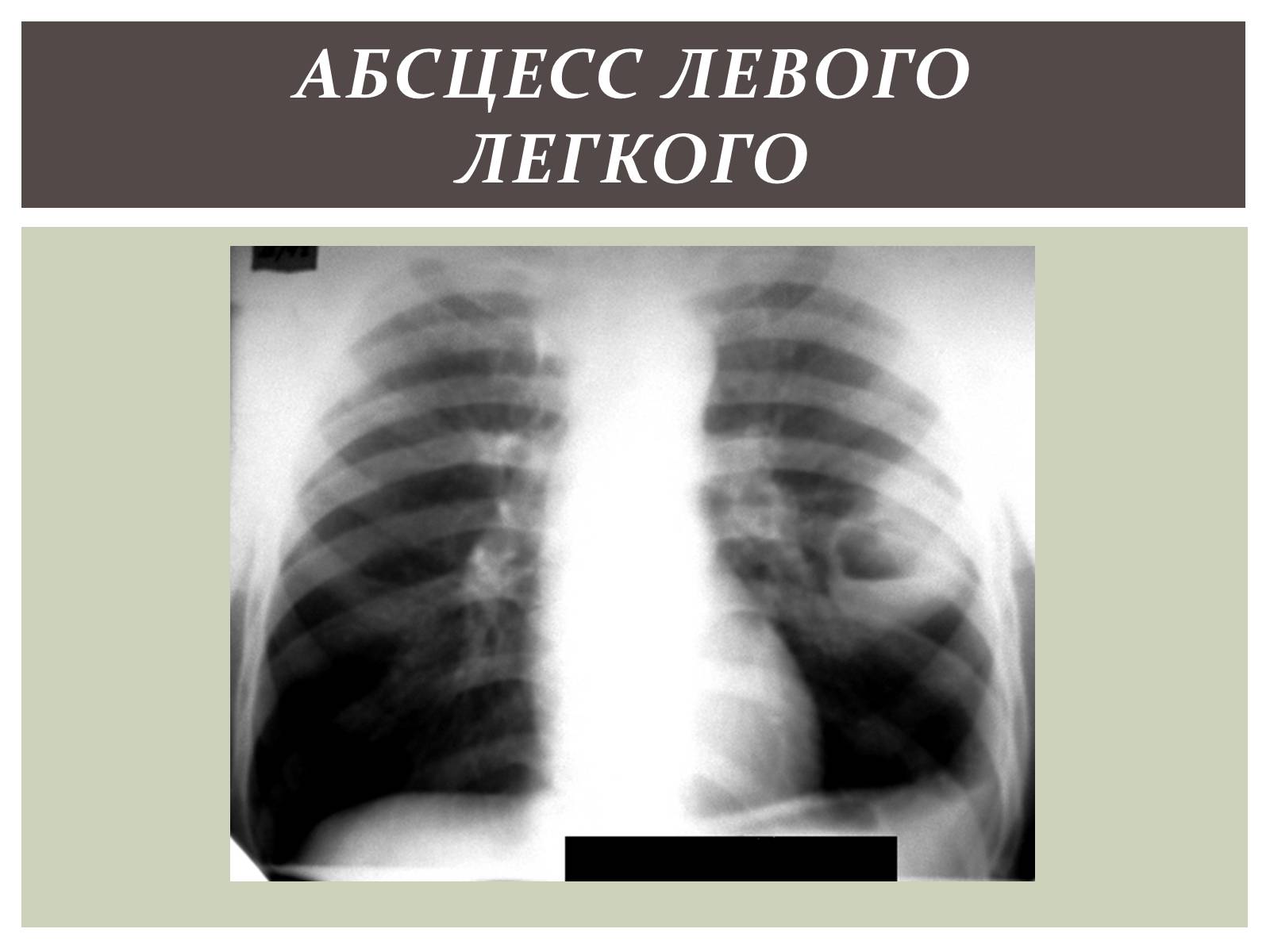 Презентація на тему «Абсцесс лёгкого» - Слайд #11 Презентація на тему «Абсцесс лёгкого» - Слайд #11