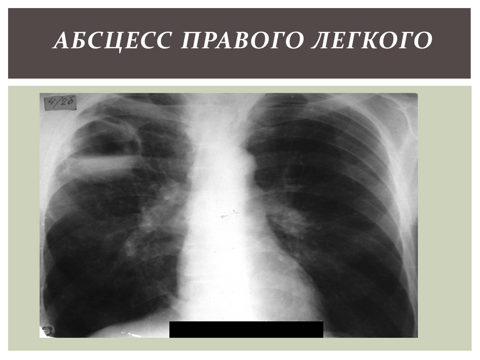 Презентація на тему «Абсцесс лёгкого» - Слайд #12 Презентація на тему «Абсцесс лёгкого» - Слайд #12