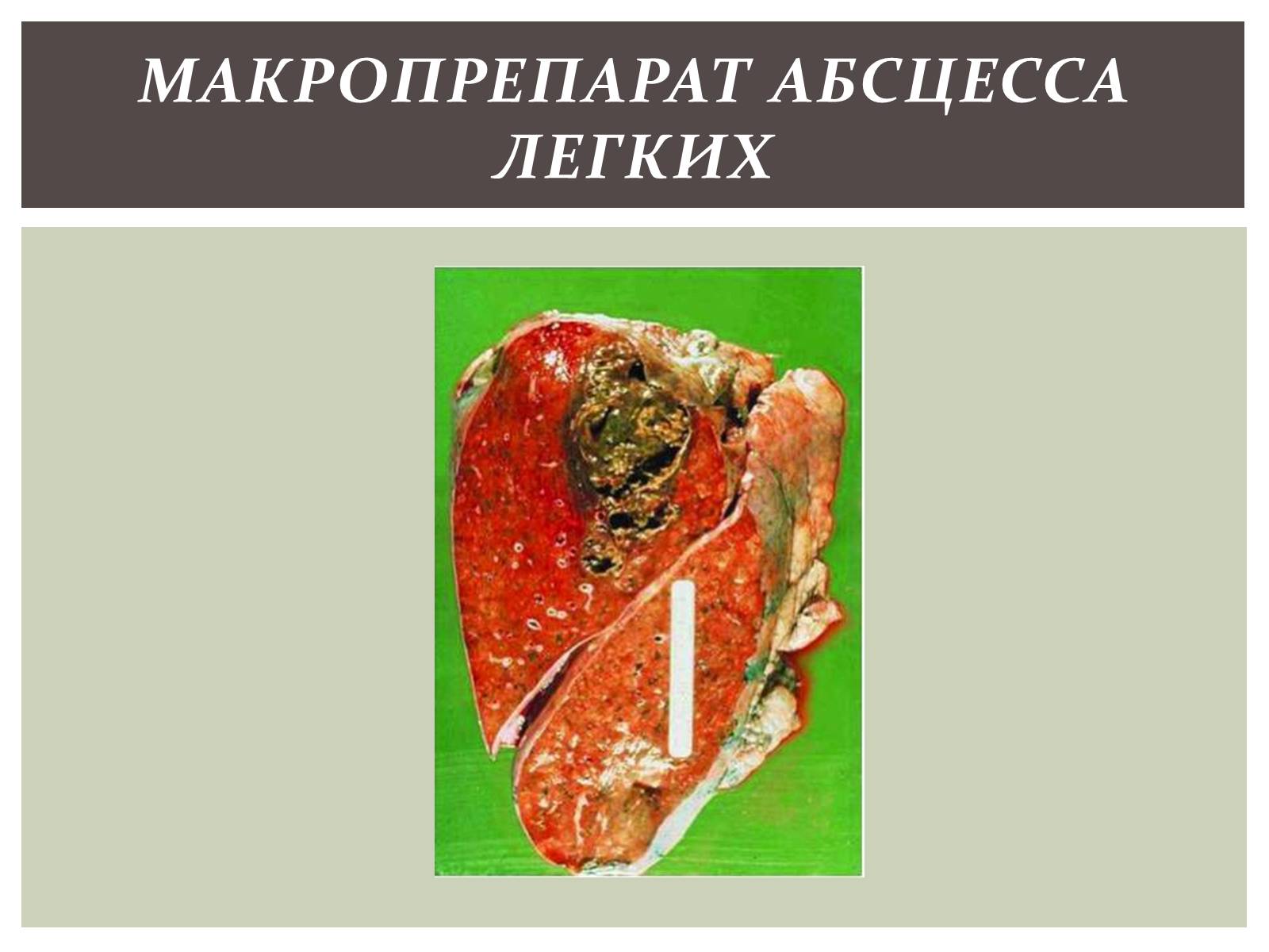 Презентація на тему «Абсцесс лёгкого» - Слайд #13 Презентація на тему «Абсцесс лёгкого» - Слайд #13
