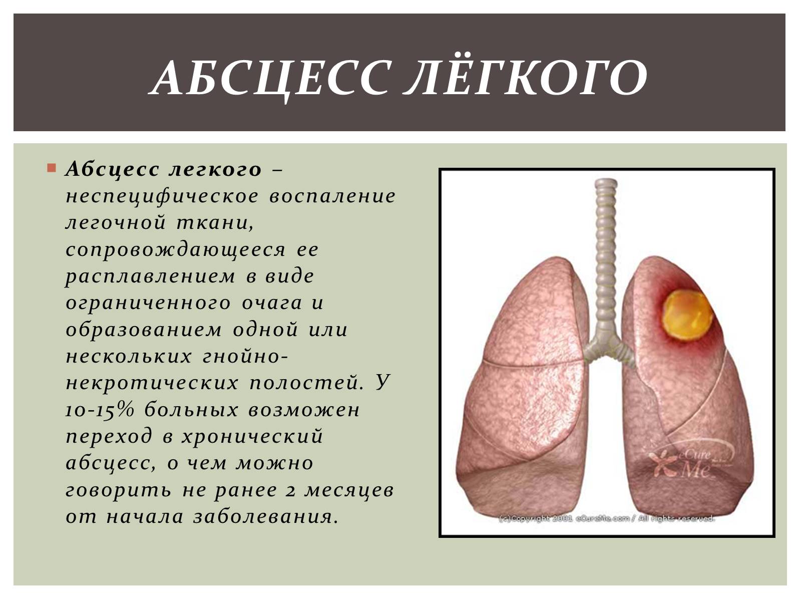 Презентація на тему «Абсцесс лёгкого» - Слайд #2 Презентація на тему «Абсцесс лёгкого» - Слайд #2