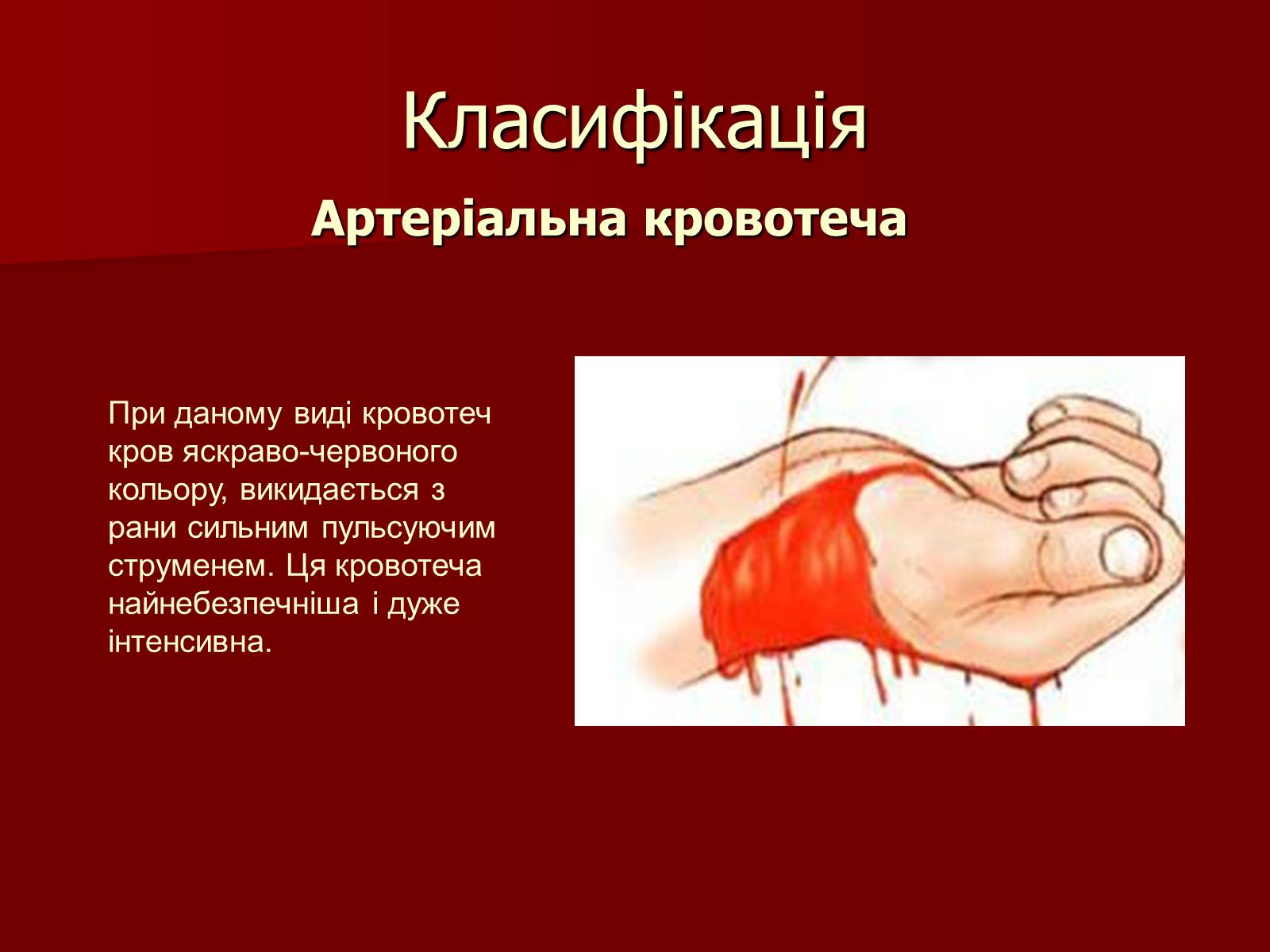 Презентація на тему «Кровотечі, їх класифікація» - Слайд #5 Презентація на тему «Кровотечі, їх класифікація» - Слайд #5